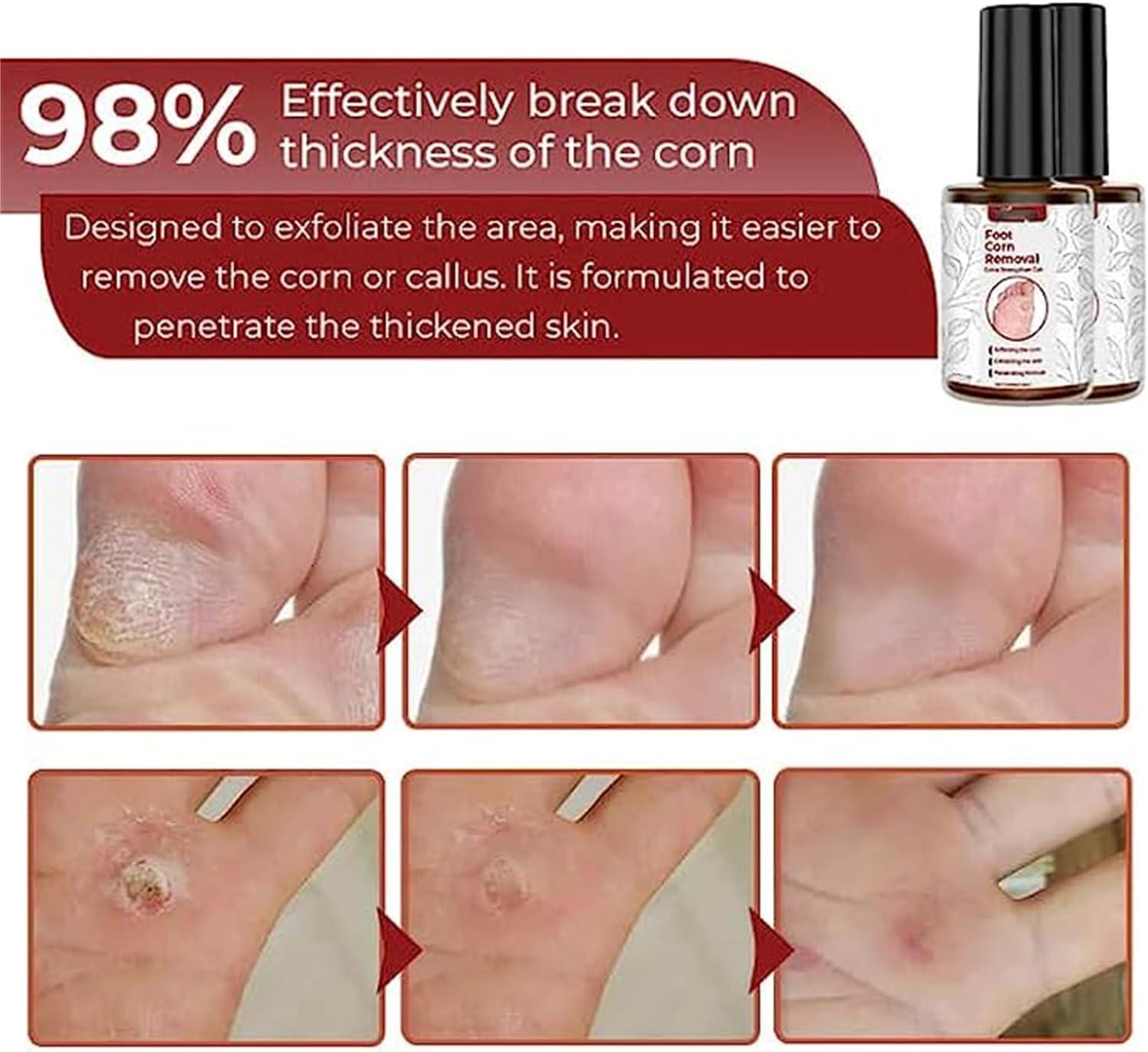 Gfouk Foot Corn Removal Extra Strengthen Gel 10ml Foot Corn Removers