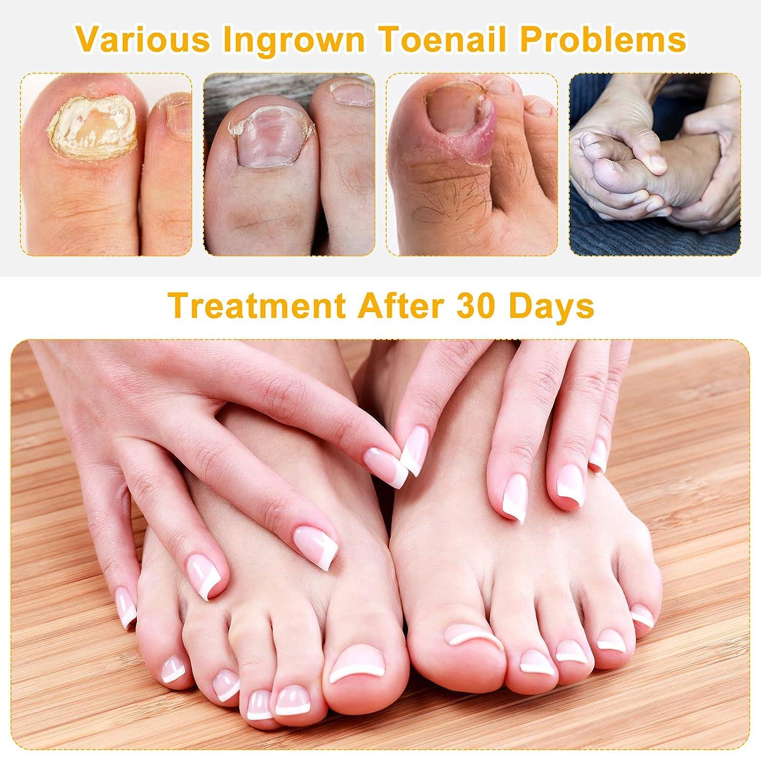 Ingrown Toenail Removal Kit 92 PCS Professional Toe Nail Treatment Tool Ingrown Toenail