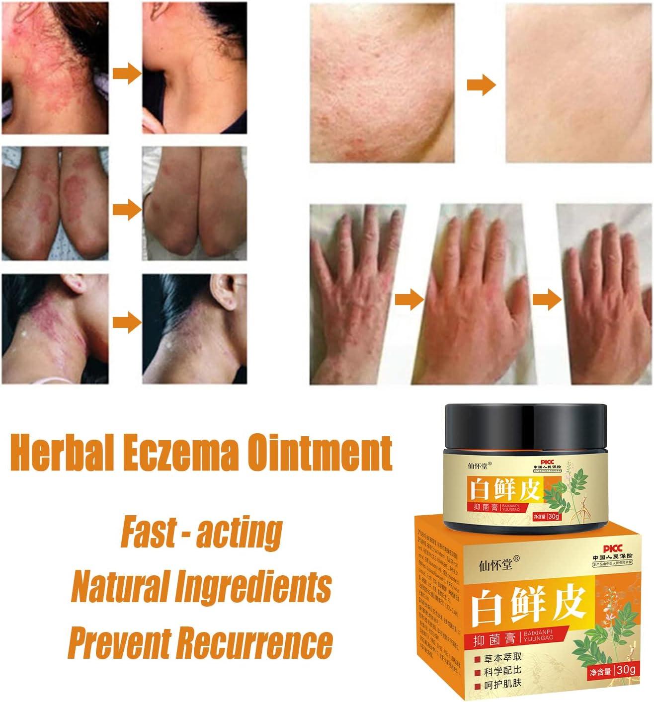 Natural Chinese Herb Eczema Psoriasis Cream for Dry & Itchy Skin Relief