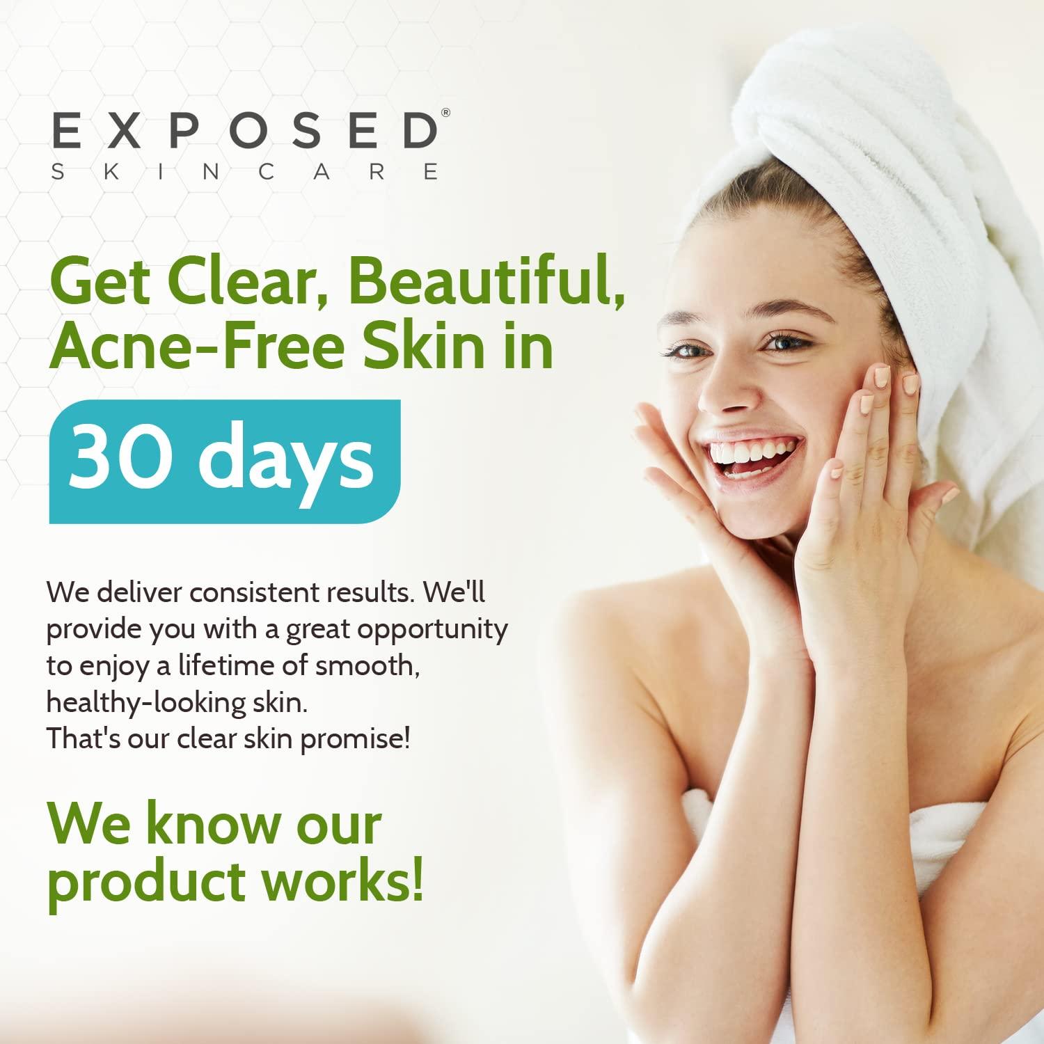 Exposed Skin Care Acne Treatment Kit Includes Facial Cleanser, Clearing Tonic, Acne Treatment