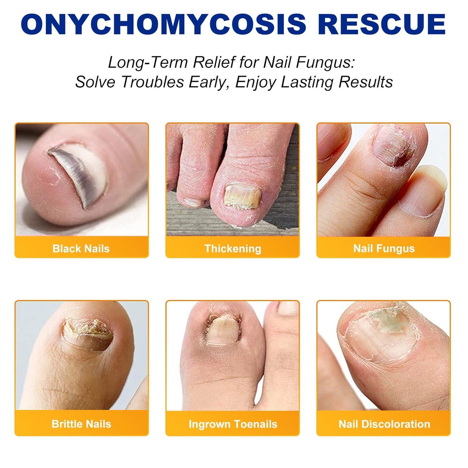 Extra Strength Toenail Fungus Treatment - 32 Pcs Fungal Nail Patches for  Nighttime Renewal & Discolored Nails | Buy Now with Express International  Delivery | GoSupps.com