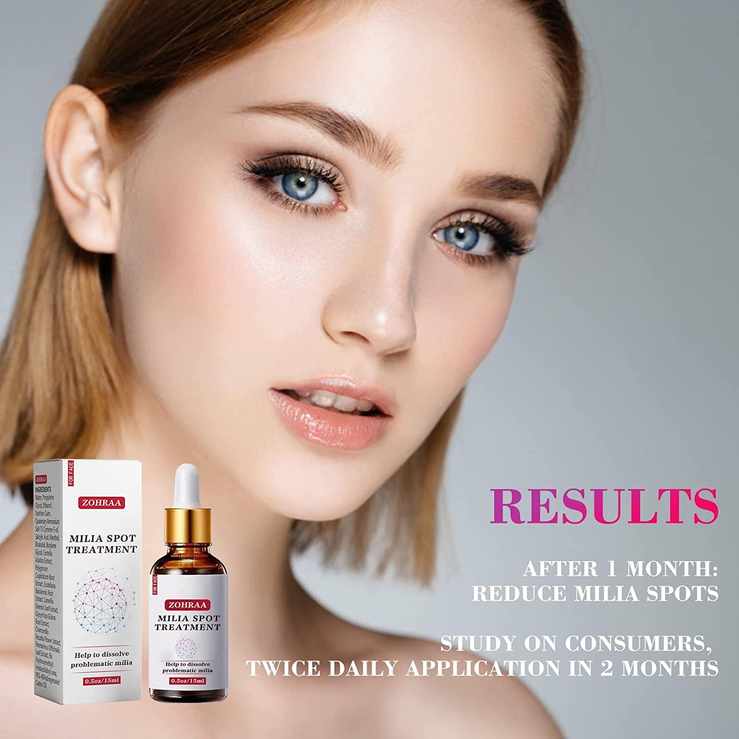 ZOHRAA Milia Remover Milia Spot Treatment Helps Dissolve and Reduce