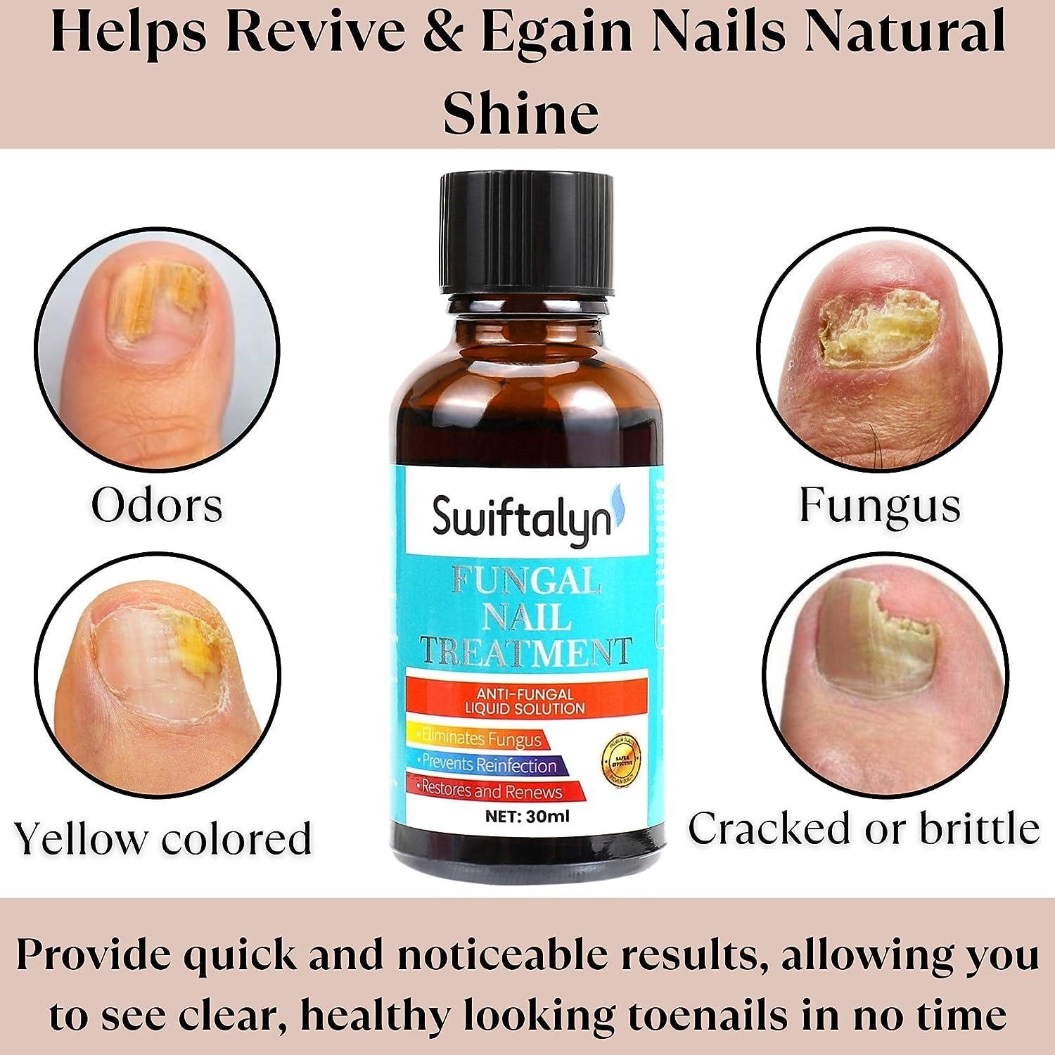 Best Toenail Fungus Treatments of 2023: Top 5 Supplements for Healthy Nails