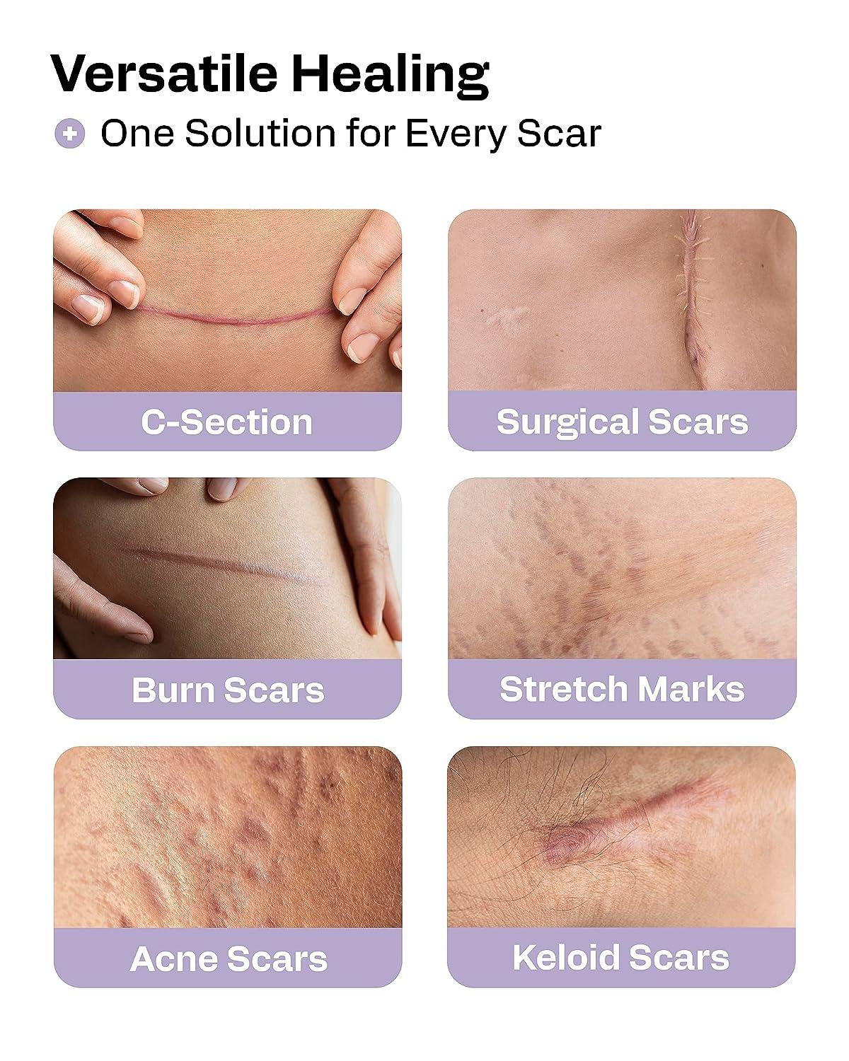 AWD Medical Silicone Scar Sheets - Silicone Gel Sheets for Scar Removal  Silic