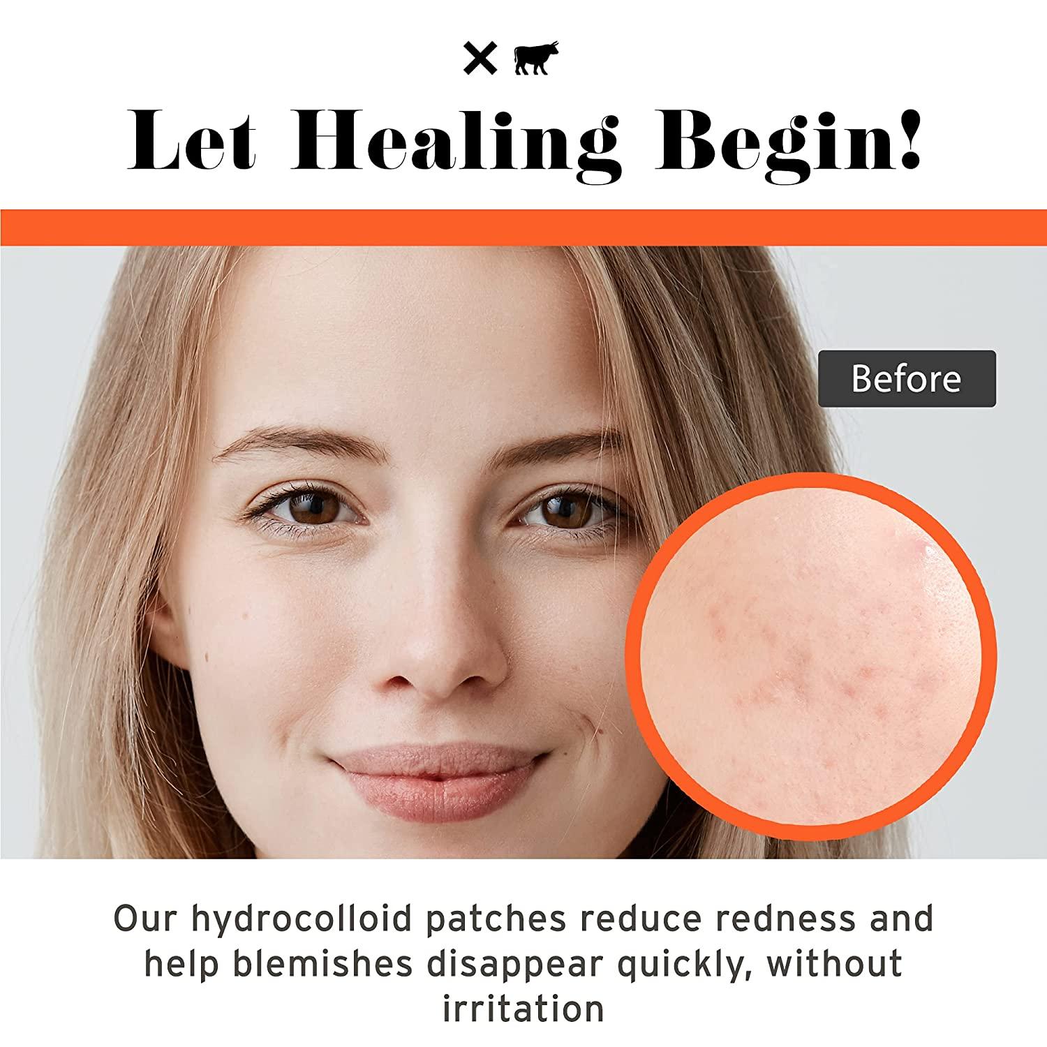 No BS Healing Acne Patches Hydrocolloid, Acne Spot Treatment, Skin