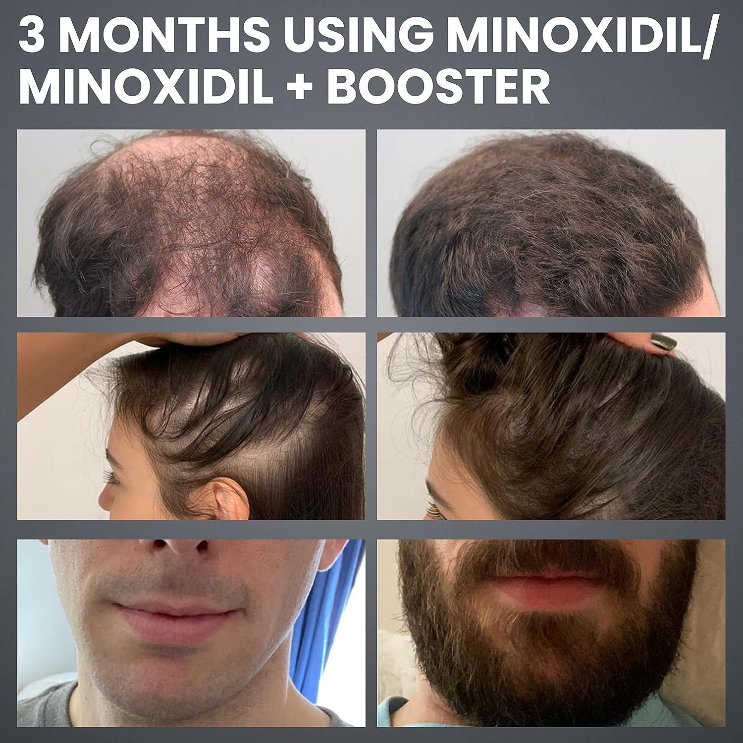 Minoxidil Booster Spray for Hair Loss - Enhances Absorption 7X for  Non-Responders with Low SULT1A1 Enzyme Levels