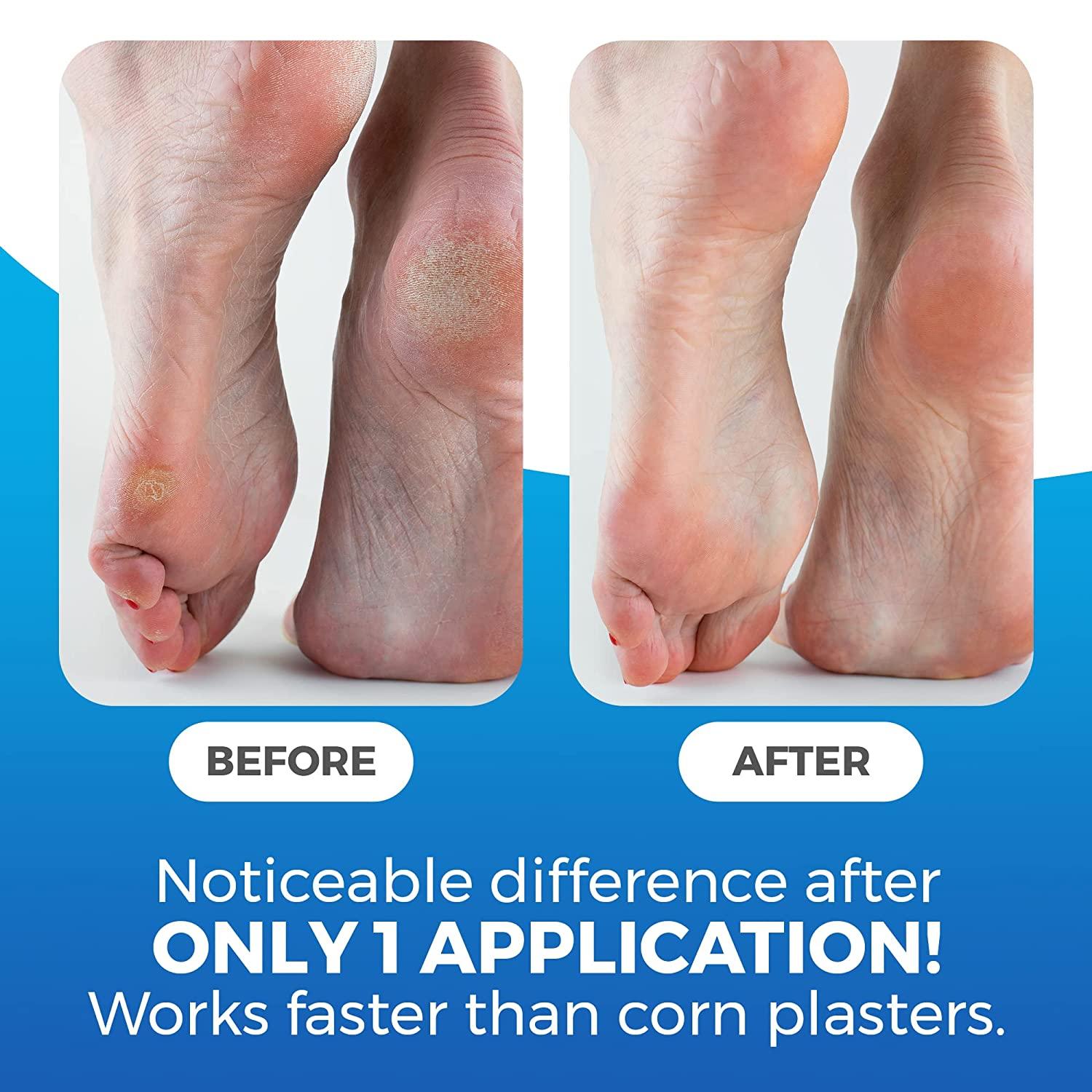 Foot Corn Removal — Bottom of Foot Callus Removal