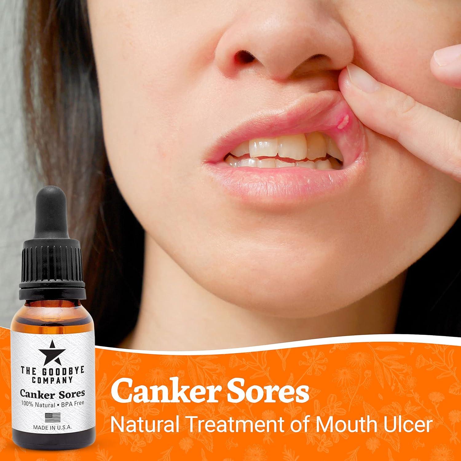 Canker Sores Treatment Helpful for Mouth Ulcer Treatment Effective