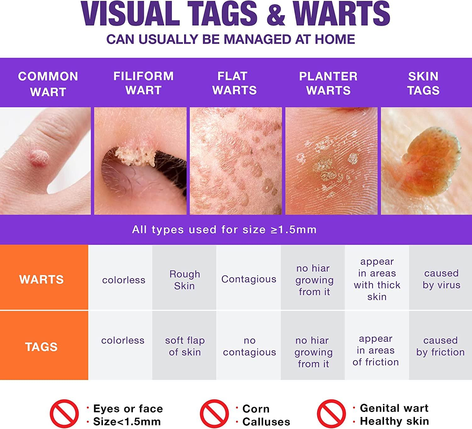 Liquid Skin Tag Remover Patches Extra Strength*2, Liquid Skin Tag