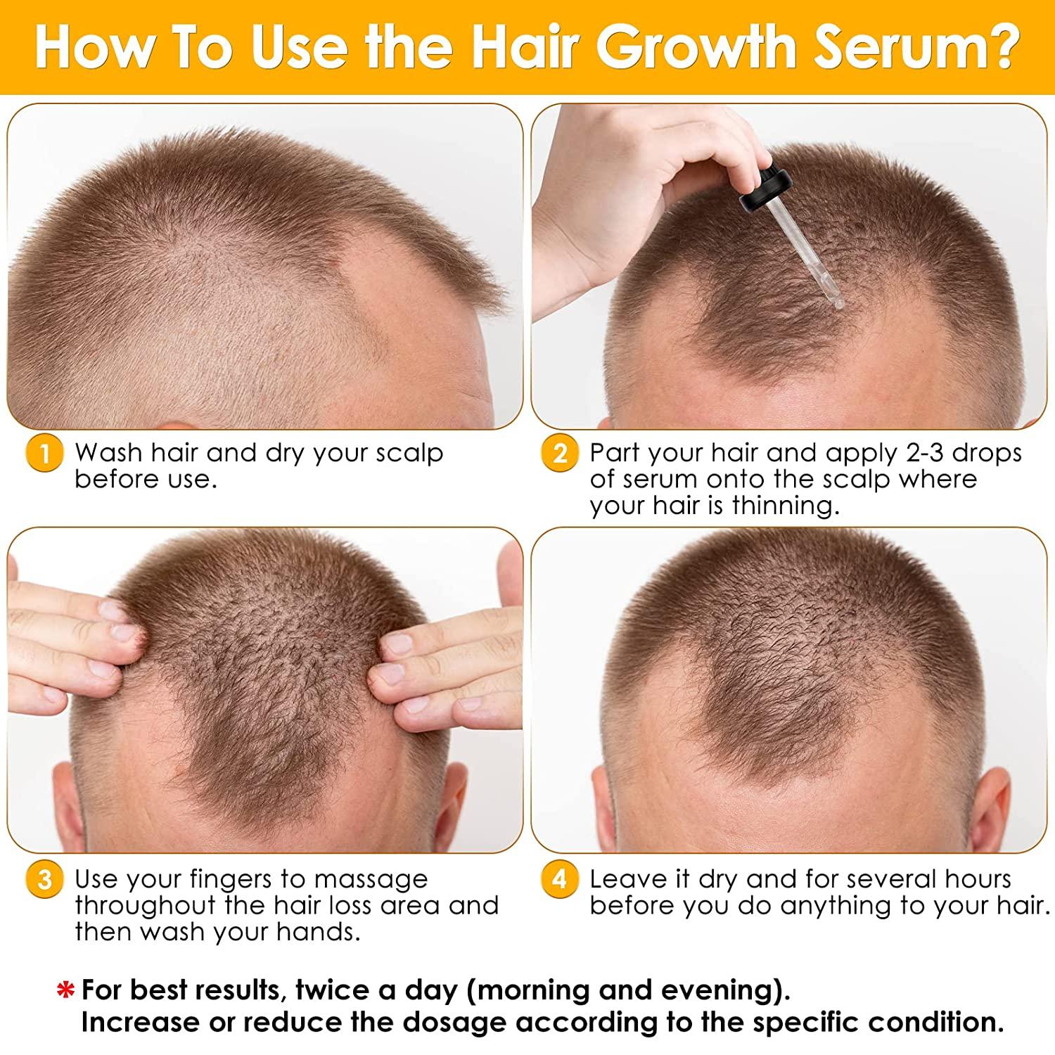 Stjerne jurist Medicinsk malpractice Minoxidil 5% Hair Growth Serum Oil Biotin Hair Regrowth Treatment for Scalp  Hair Loss Hair Thinning, Hair Growth Serum for Men Women 1 fl.oz Black