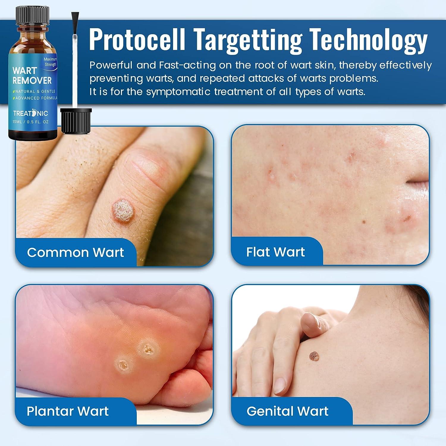 Treatonic Wart Remover Gel Fast Acting Plantar Wart Removal for Feet