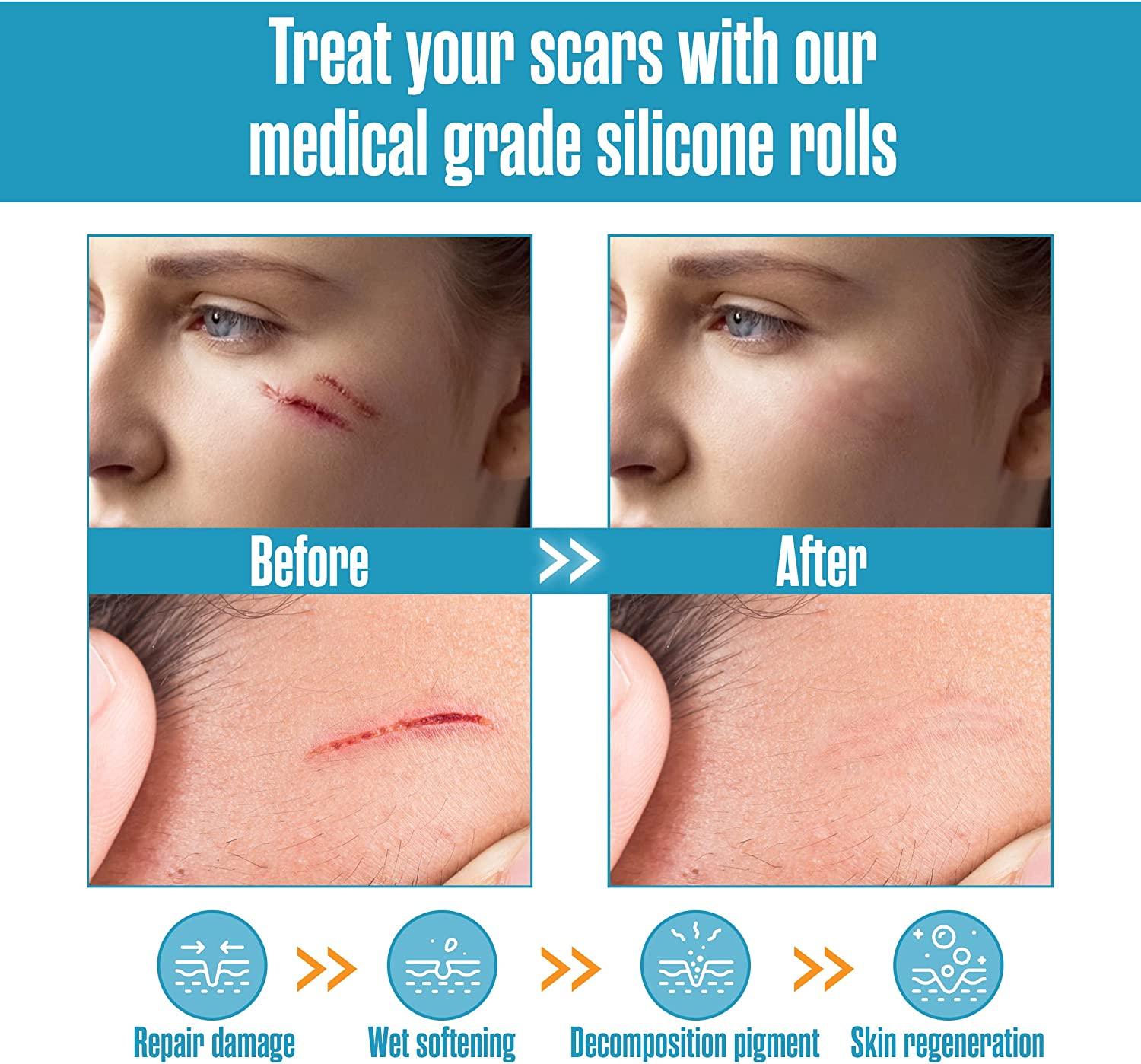 Houseables Silicone Scar Sheets Gel Tape 1.57 x 60 Tan, Flexible