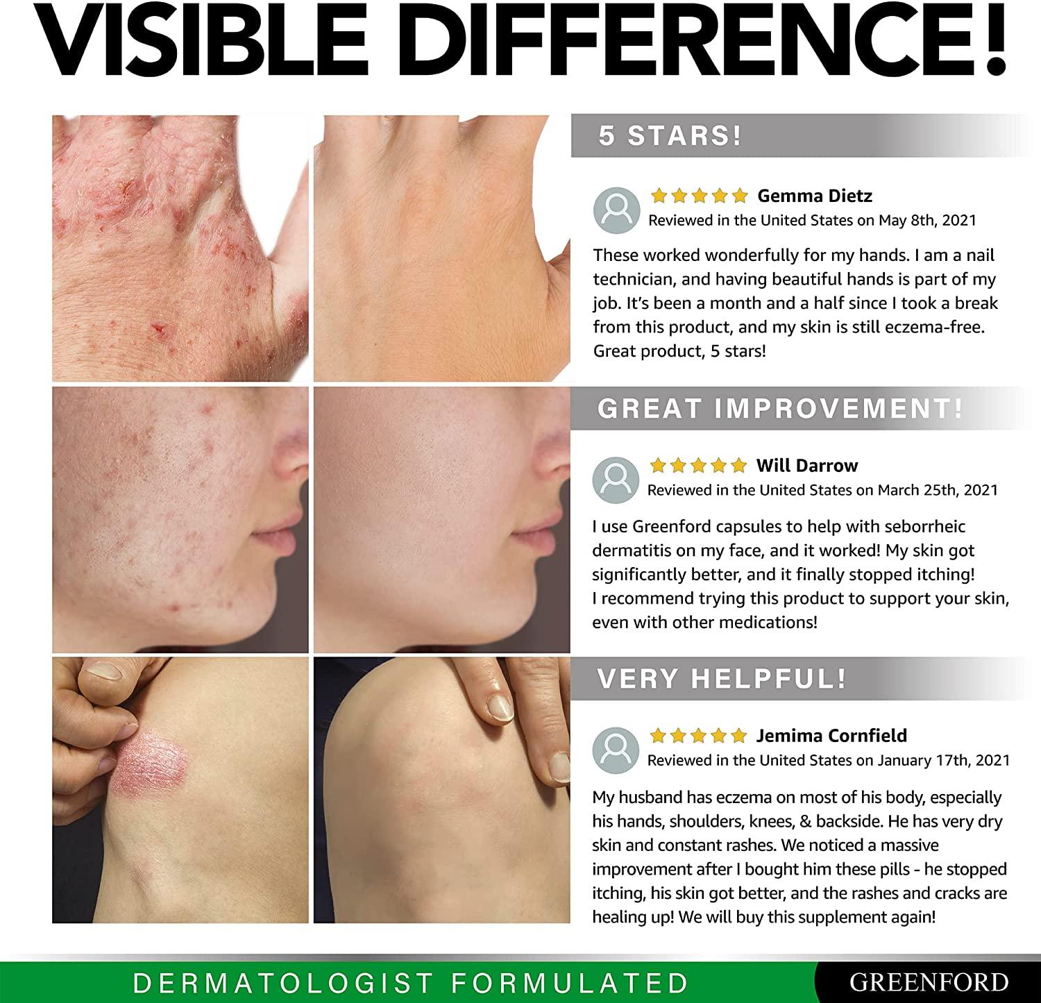 Natural Eczema Relief Supplement USA Made Alternative to Dupixent