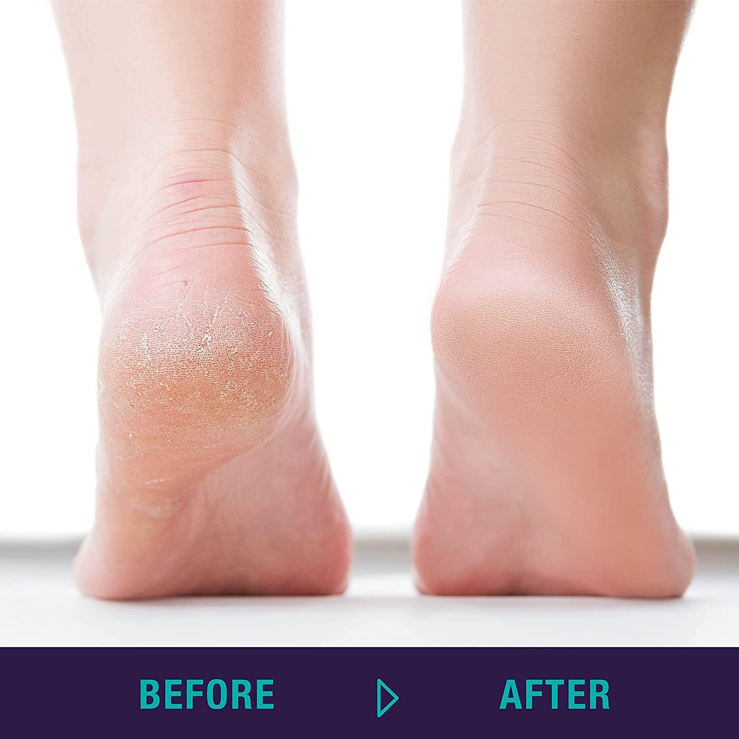 TRIM Simply Foot Exfoliating Stone Foot File 360Degree Abrasive