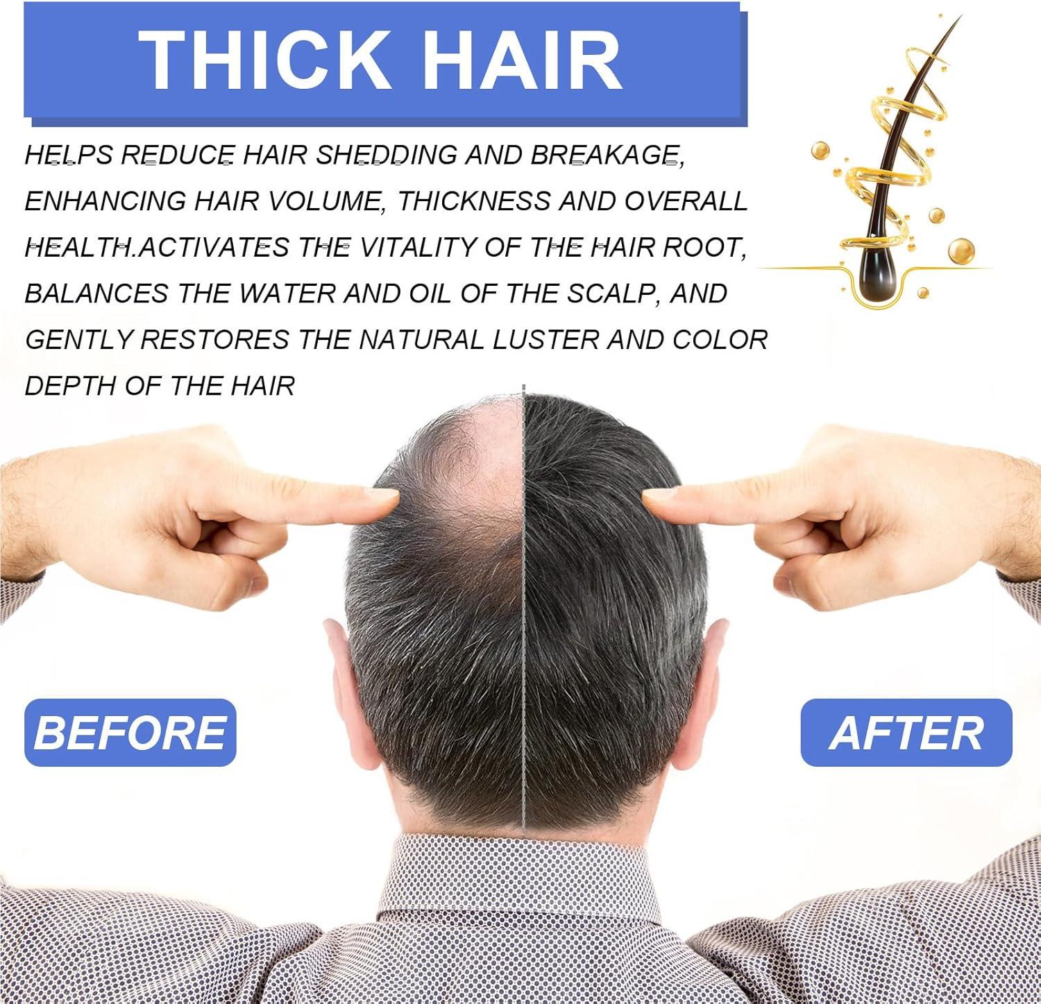 KOAHDE Hair Regrowth Foam for Men Hair Regrowth Spray Foam Hair