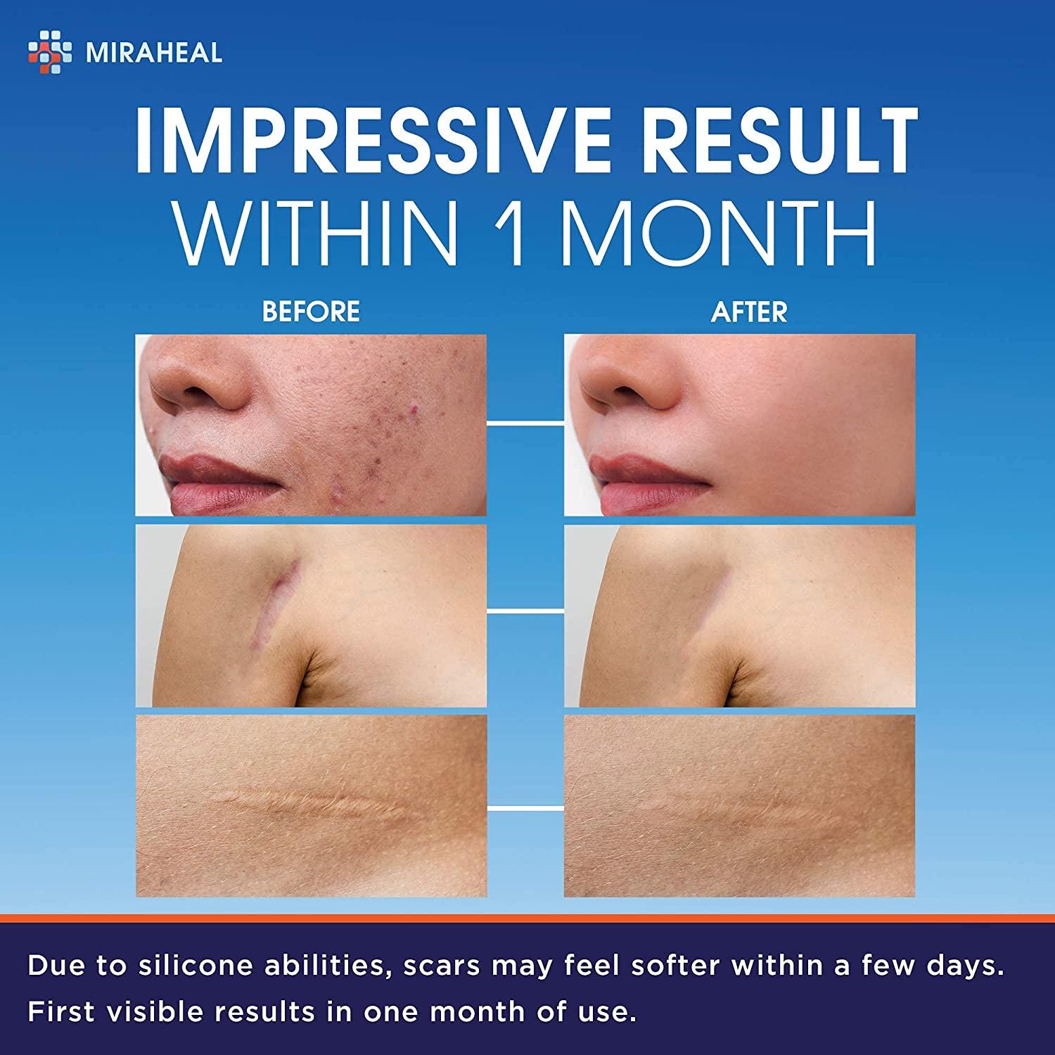 Silicone Scar Sheets 5.7" x 1.57" Keloid Scar Removal for Surgical