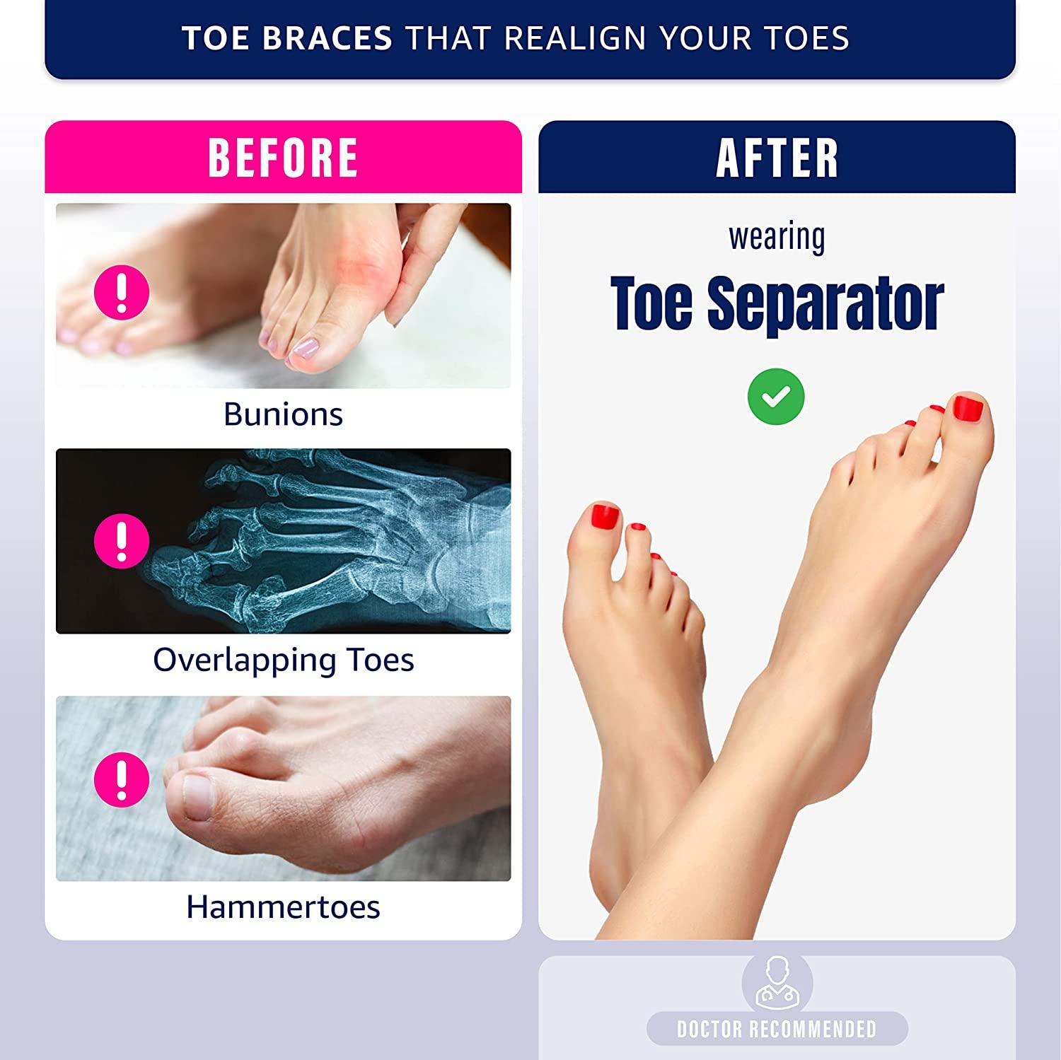 Toe Separator and Stretcher Highly Effective Toe Straightener for