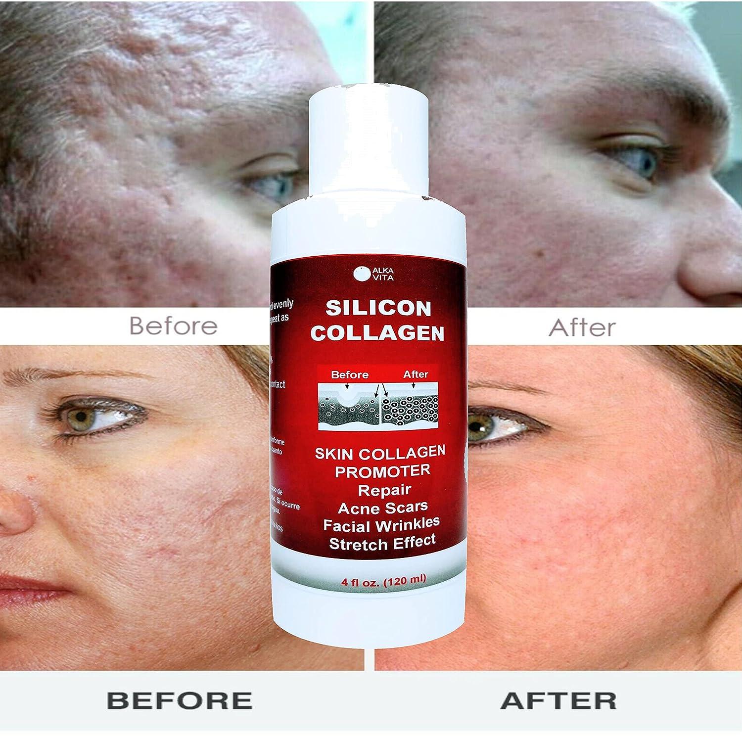 Does Taking Collagen Increase Scar Tissue ALKA VITA Silicon & Collagen Gel for Indented Facial Scars - Skin