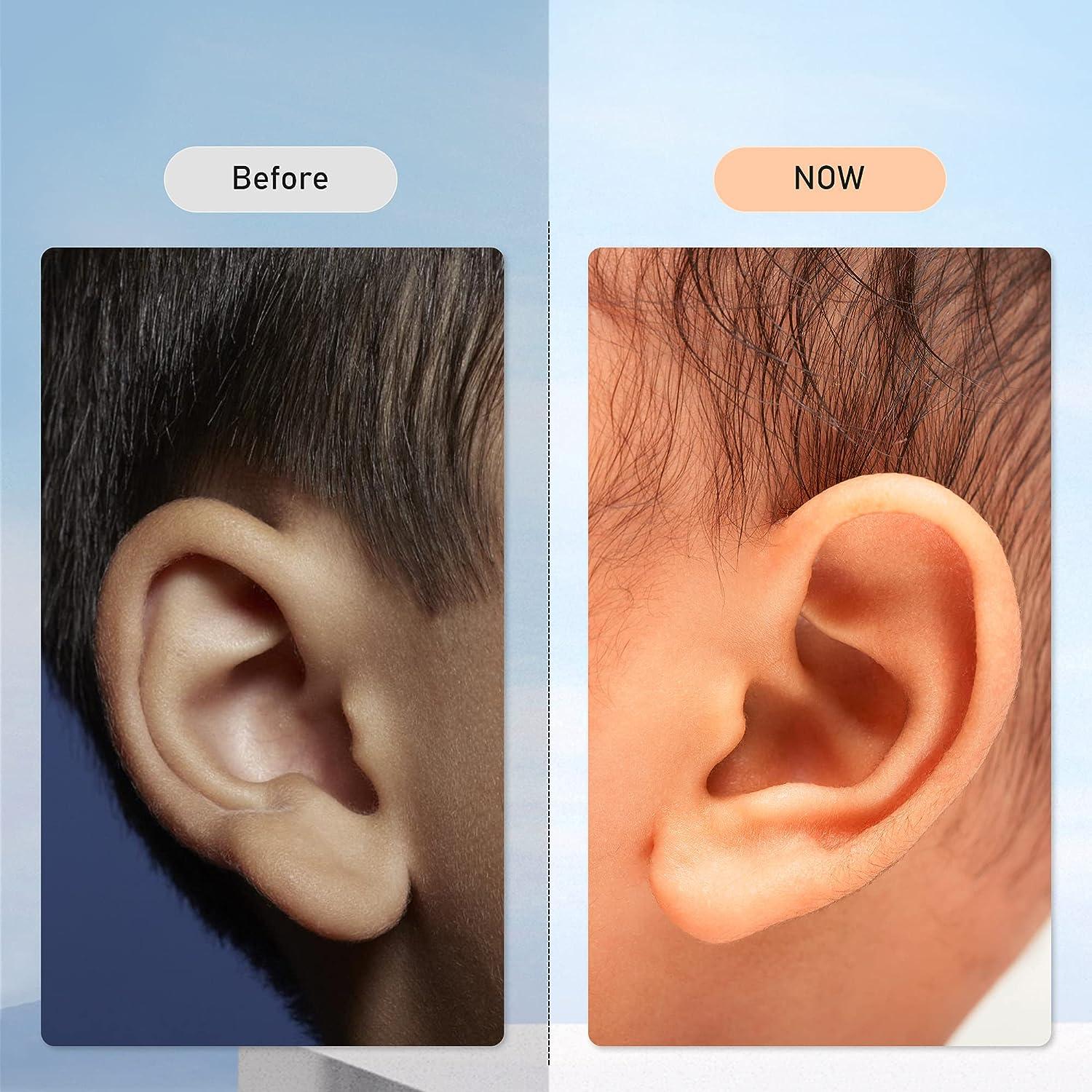 Sanfe Elephant Protruding Ear Corrector Orthopedic Baby Item for