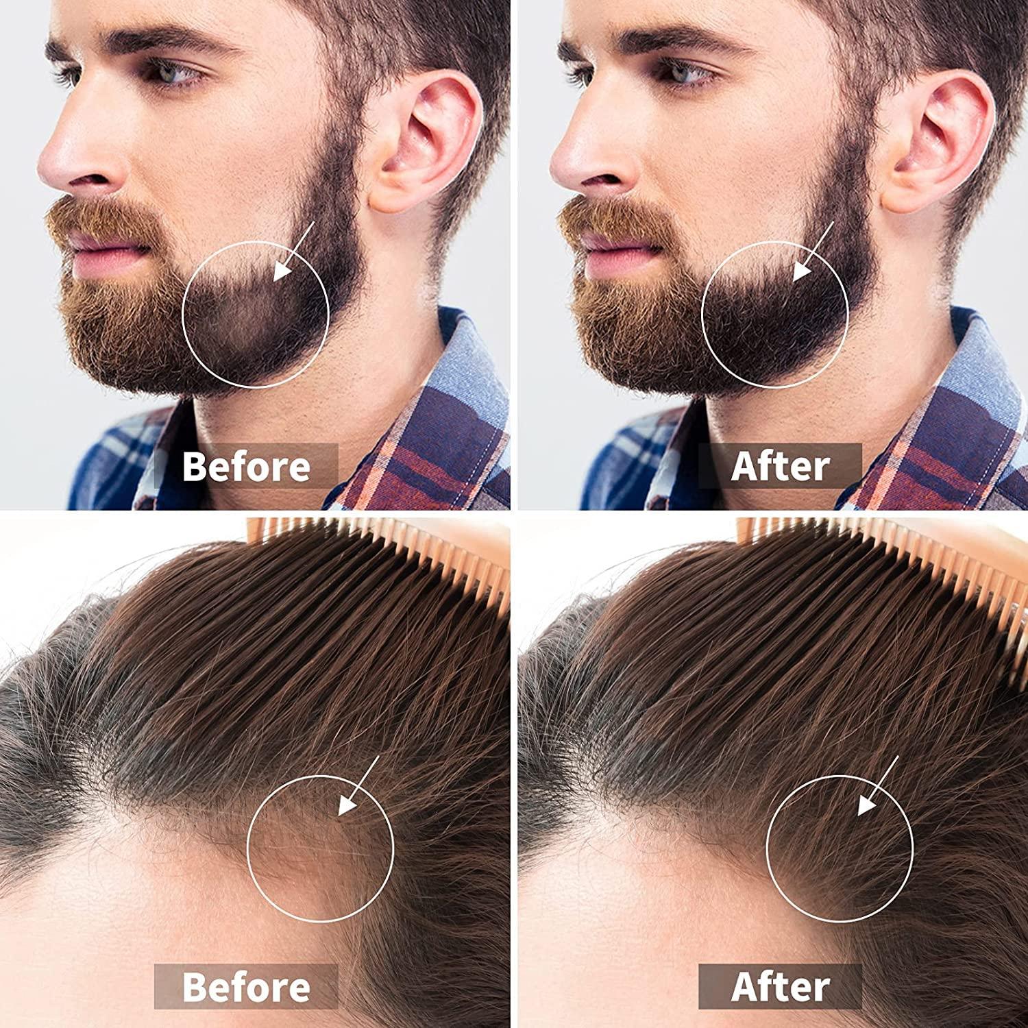 Derma Roller for Hair & Beard Growth Microneedling Roller for Face