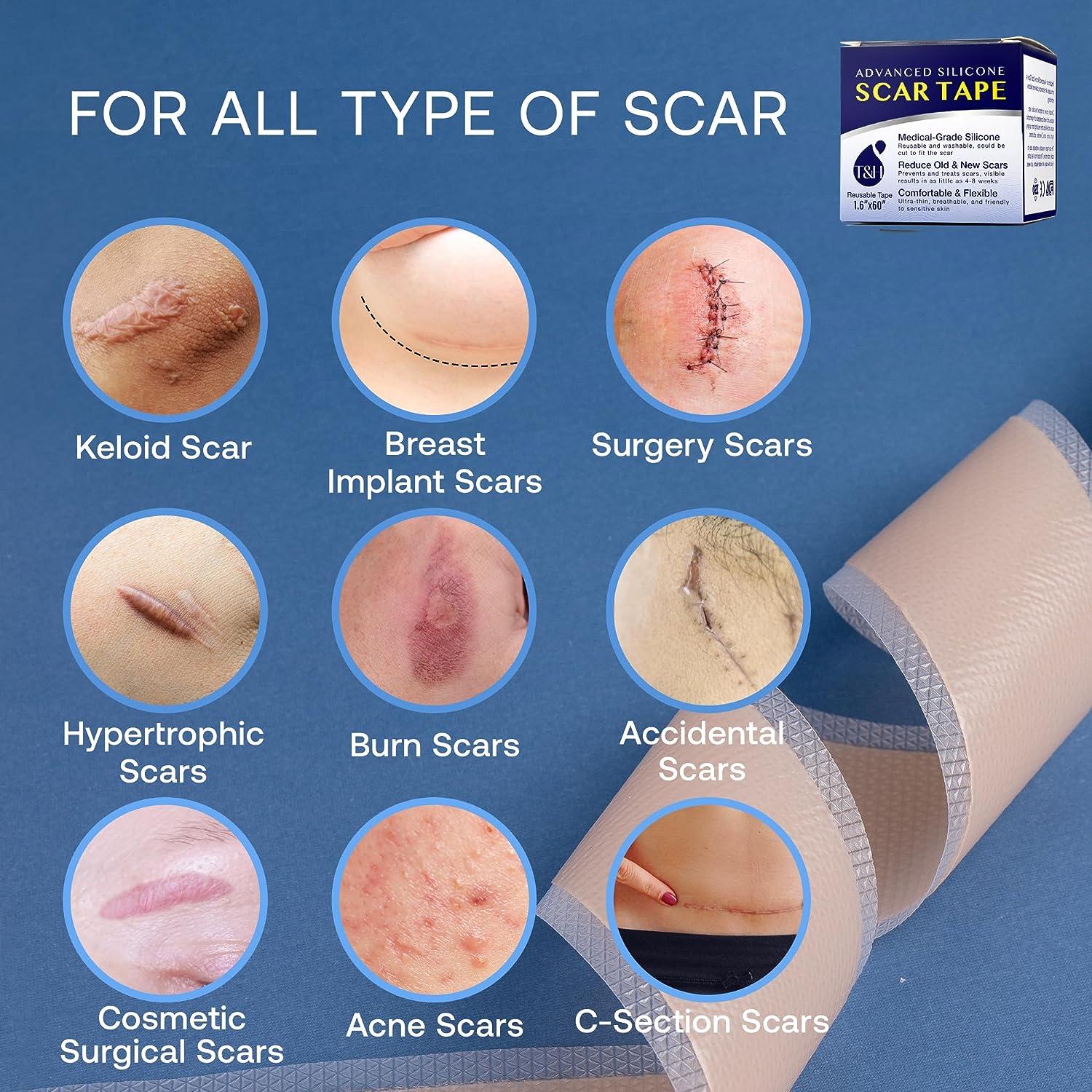 Silicone Scar Sheets Medical Grade Silicone Tape Strips for Scars