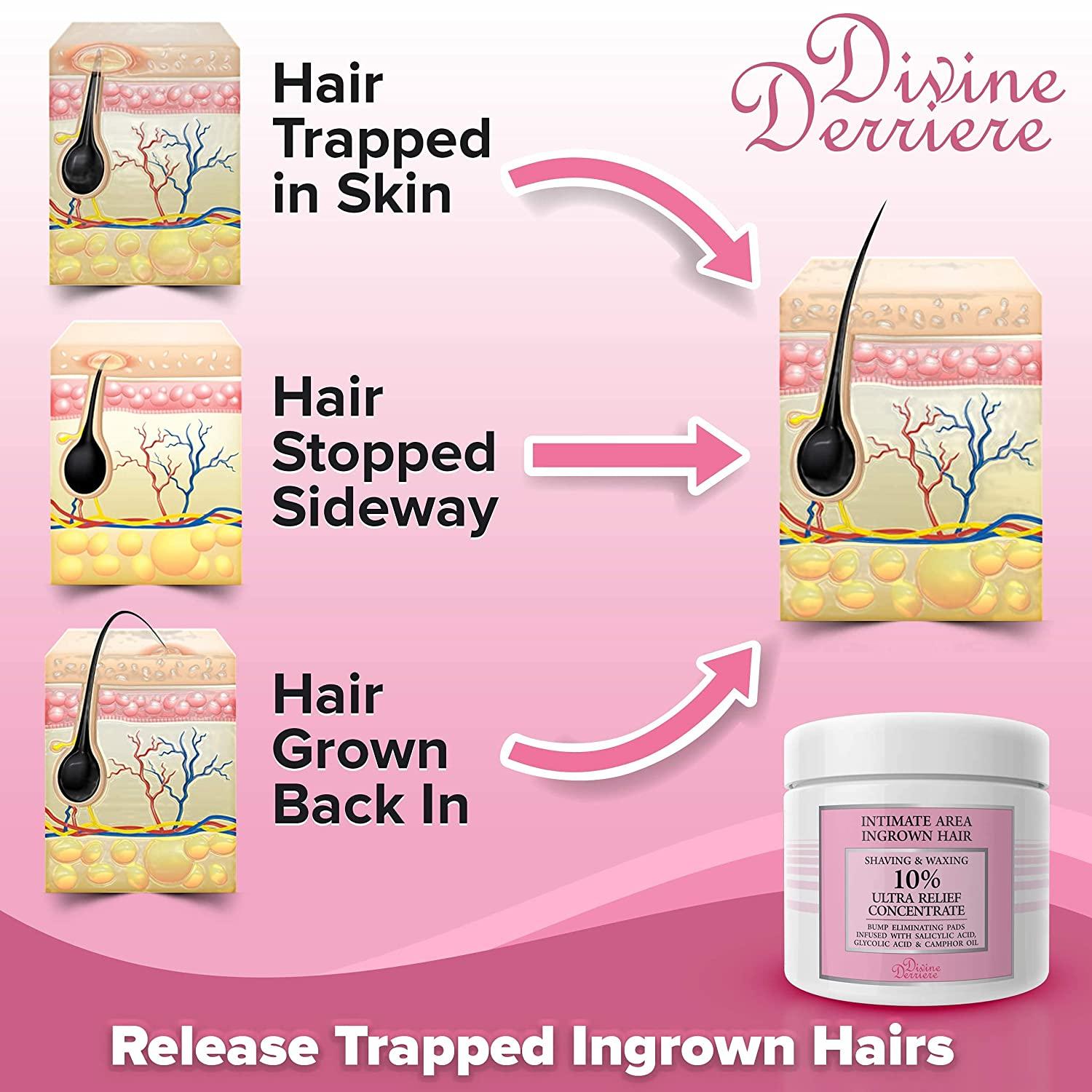 Divine Derriere Ingrown Hair Treatment Pads (Razor Bump Stopper) After
