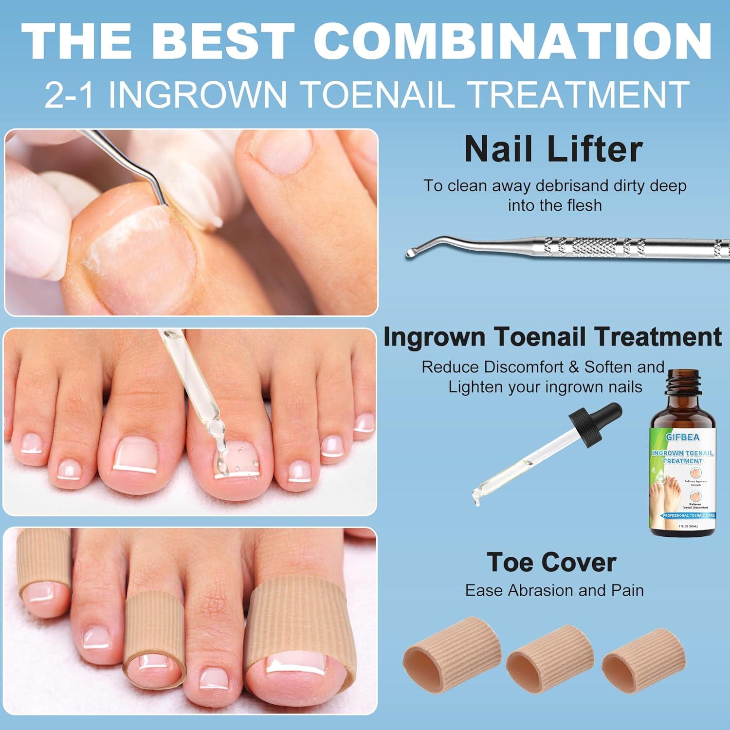 Ingrown Toenail Treatment Kit Drops Softener Double-Sided