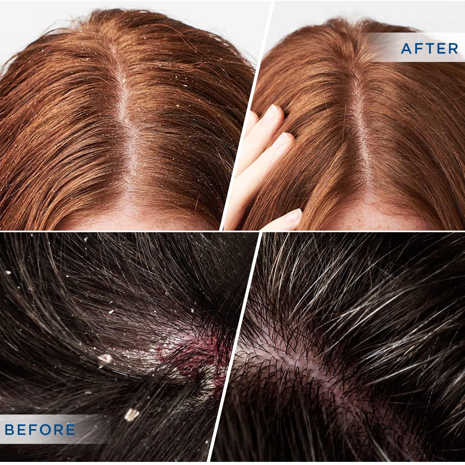 DERPHEA Psoriasis Shampoo Folliculitis Shampoo Seborrheic Dermatitis