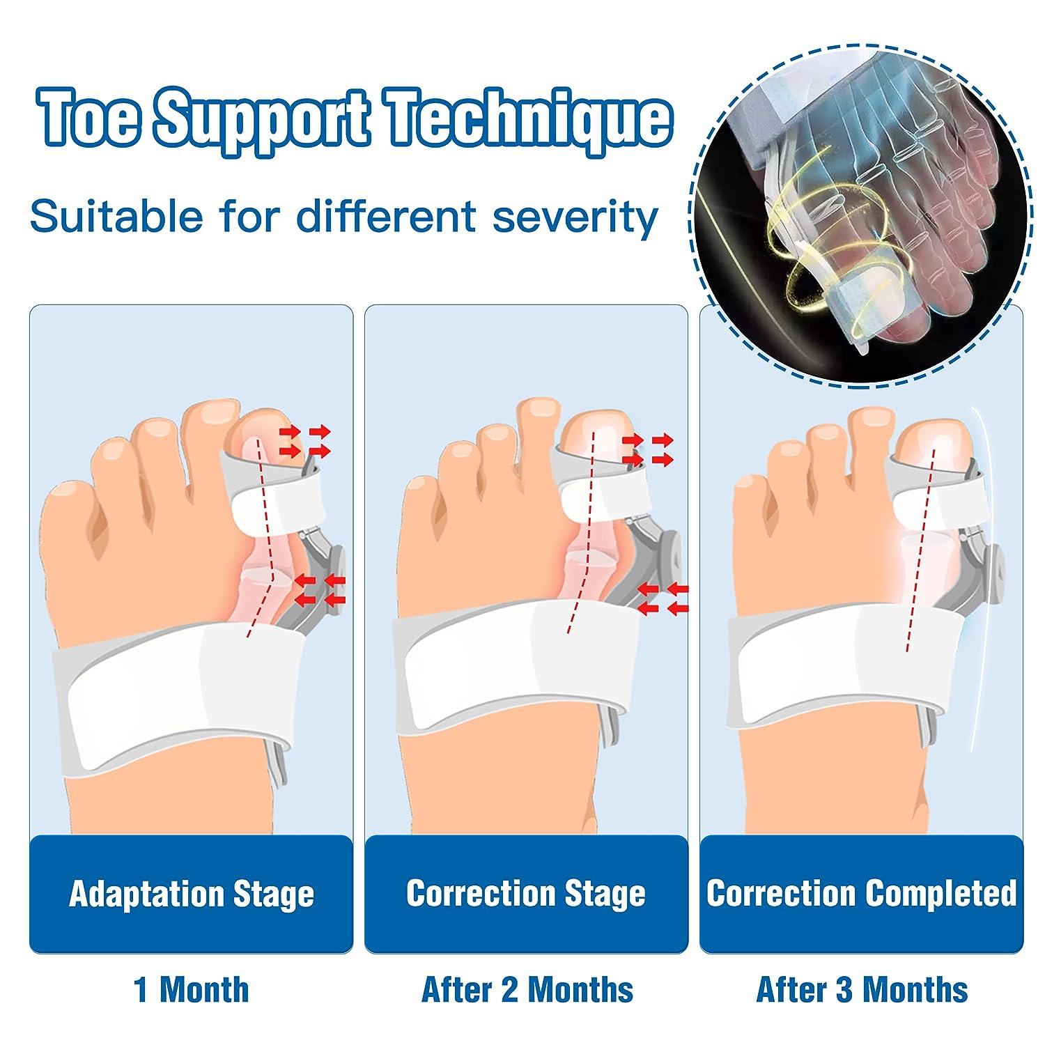 TENICORE Bunion Corrector for Kids, Hallux Valgus Bunion Brace Big Toe