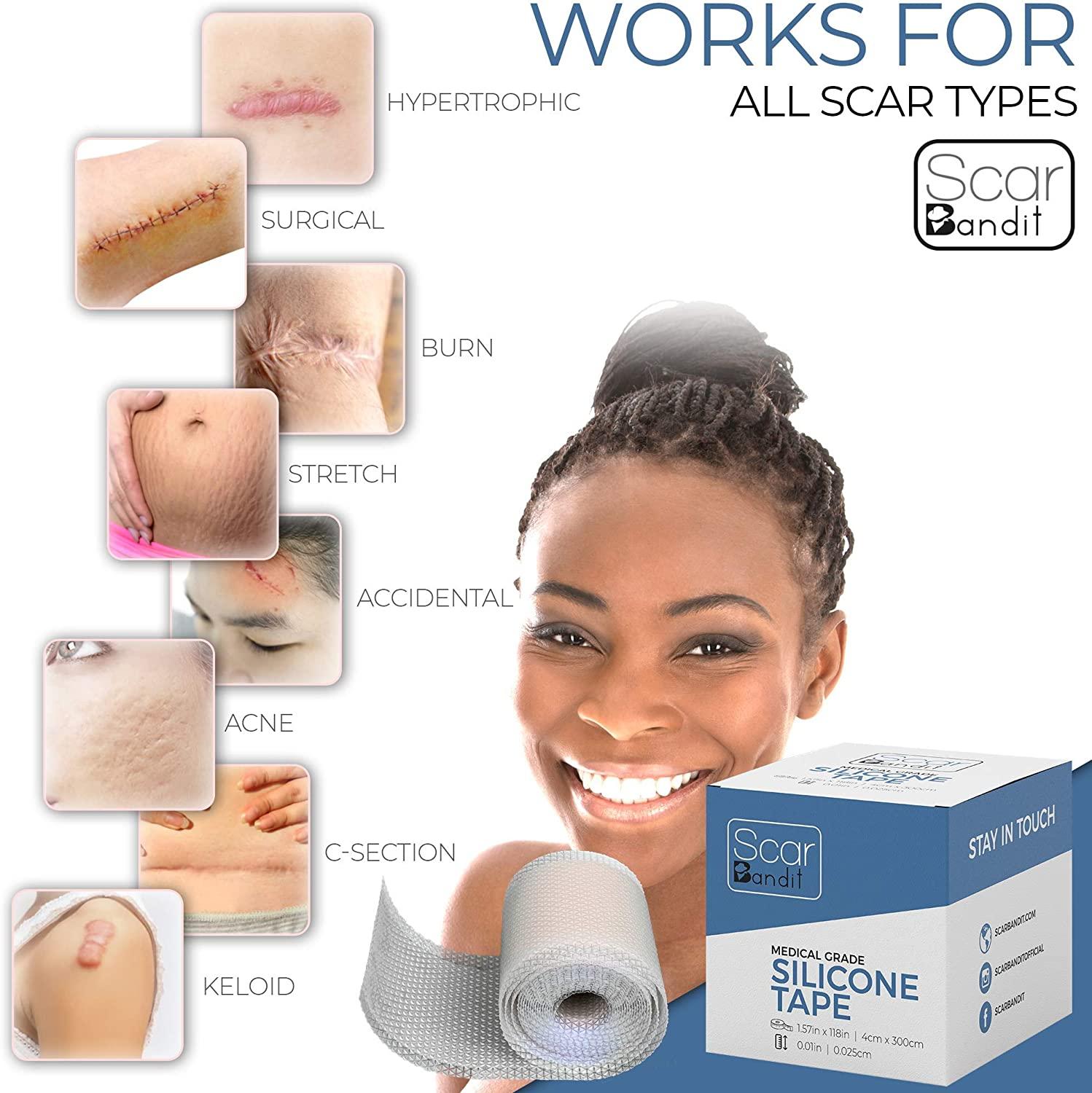 Scarbandit Silicone Scar Sheets Scars Removal Treatment Keloid Bump