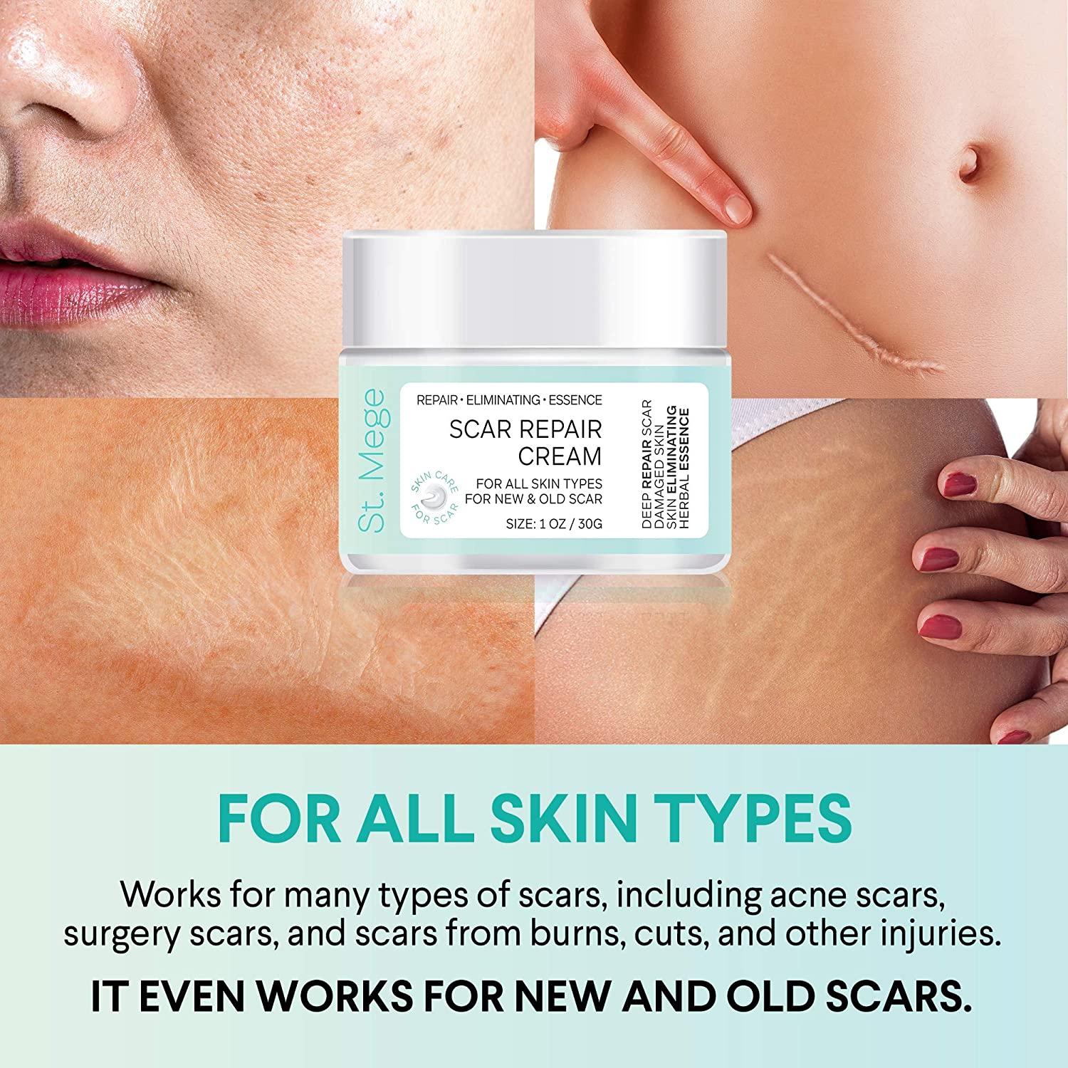 Scar Removal Cream for Old Scars Stretch Mark & Burn Repair Face