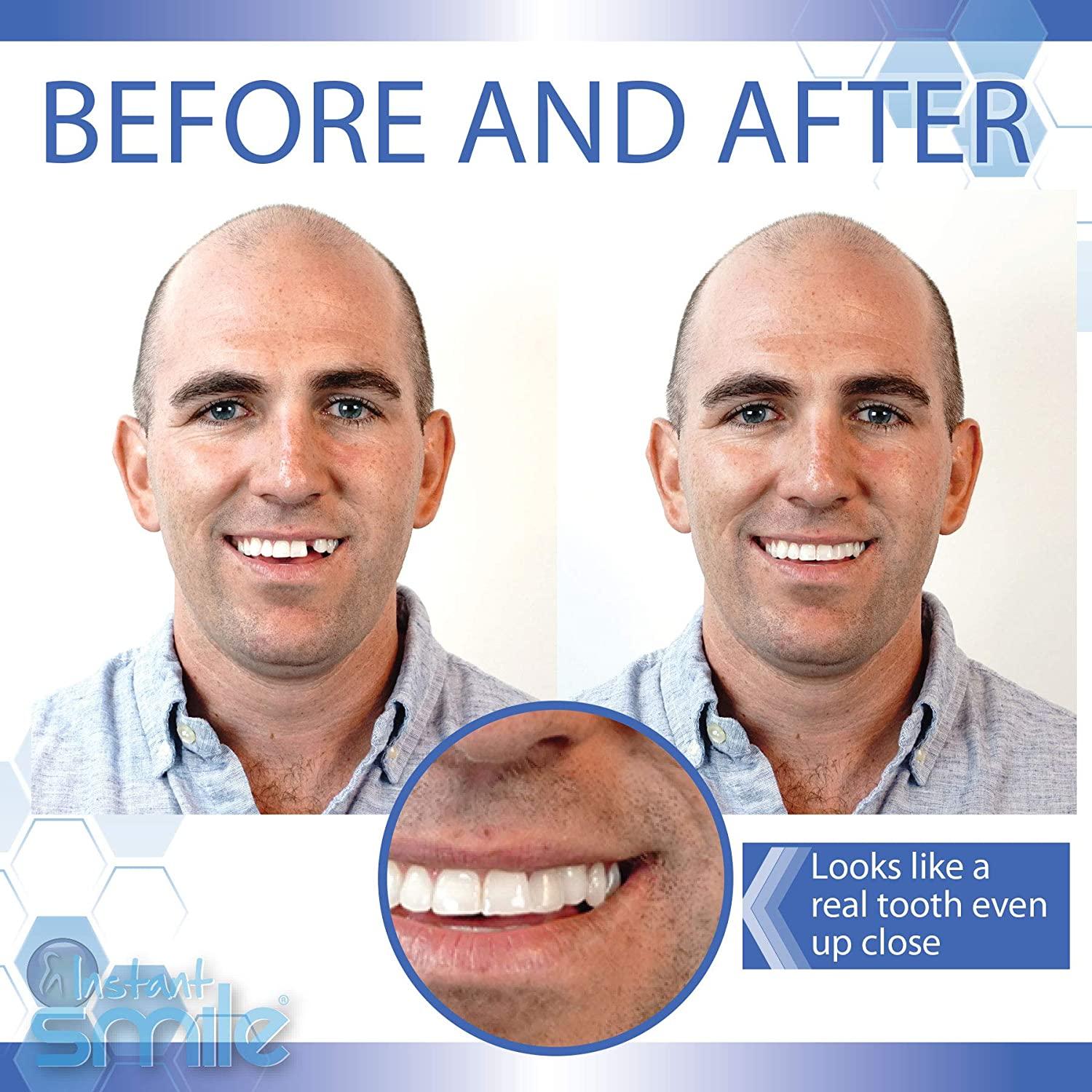 Instant Smile MULTISHADE Temporary Tooth Repair Kit Realistic Missing/Broken Tooth Fix