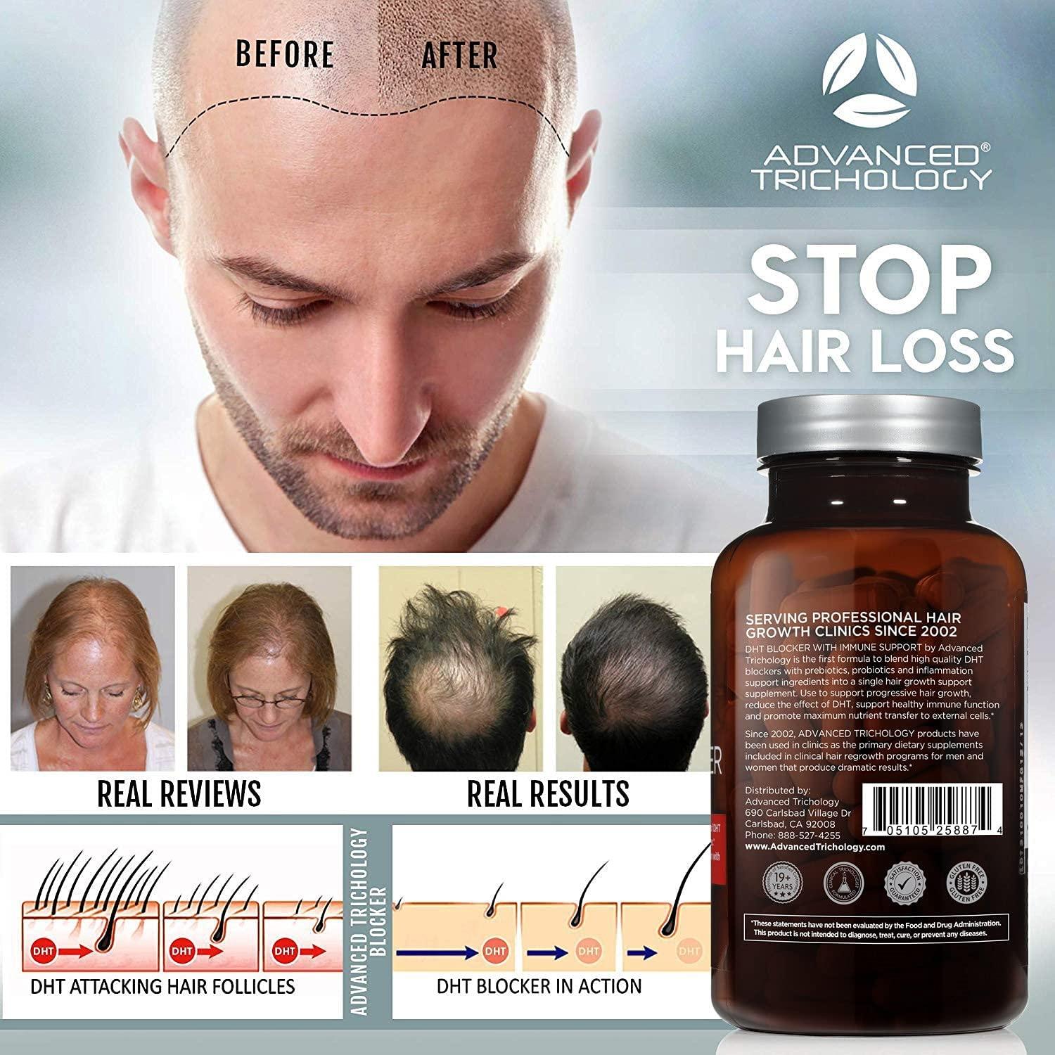 DHT Blocker - Hair Growth Supplement for Genetic Thinning for Men and Women  | Approved* by American Hair Loss Association | Guaranteed, Backed by 20  Years of Experience in Hair Loss Treatment Clinics
