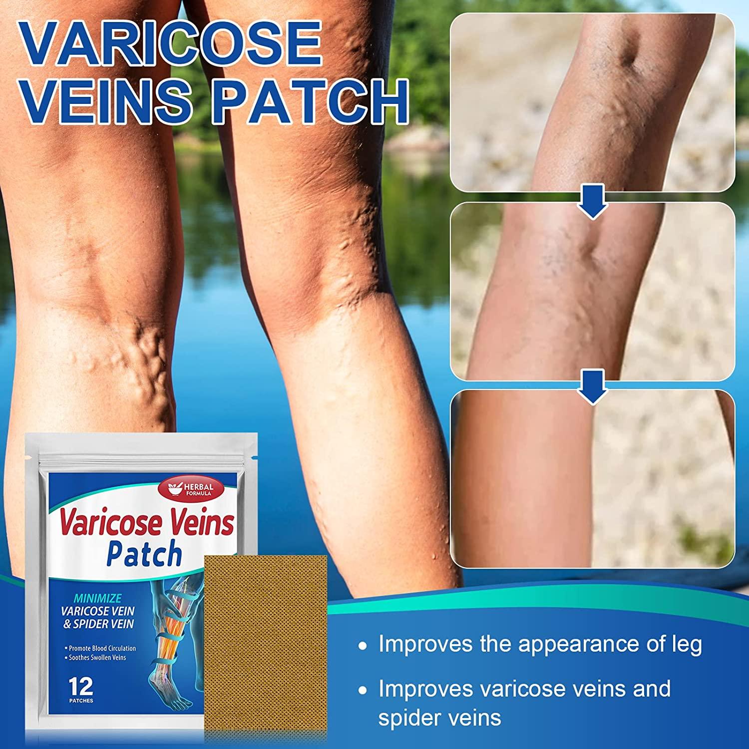 Varicose Veins Treatment for Legs, Varicose Veins Patch for Spider Veins,  Vasculitis, Leg Pain relief Treatment Patch, Improve Blood Circulation and  Vascular Health 12Pcs