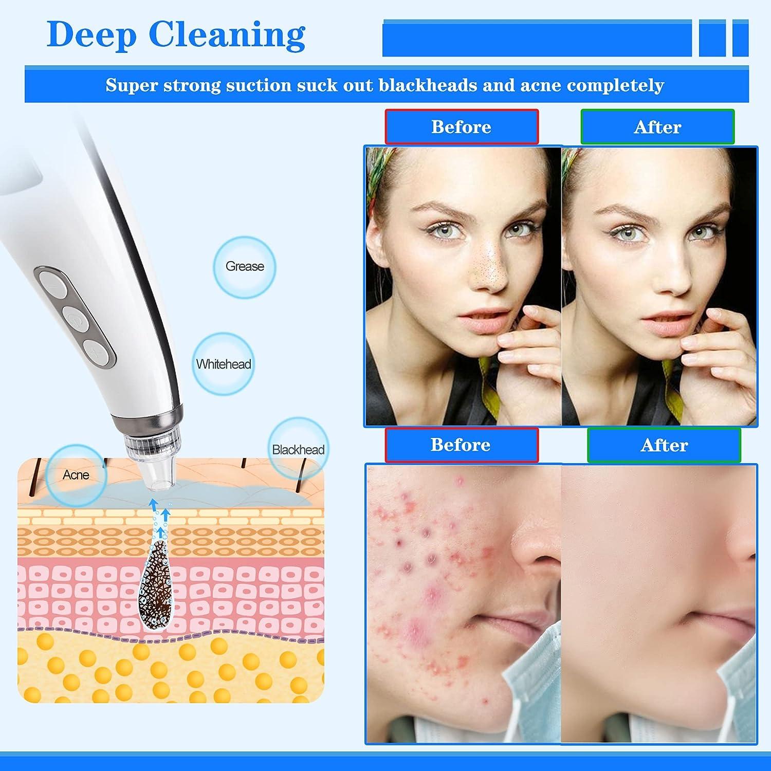 2023 Newest Tunbot Blackhead Remover Pore Vacuum Cleaner, Rechargeable