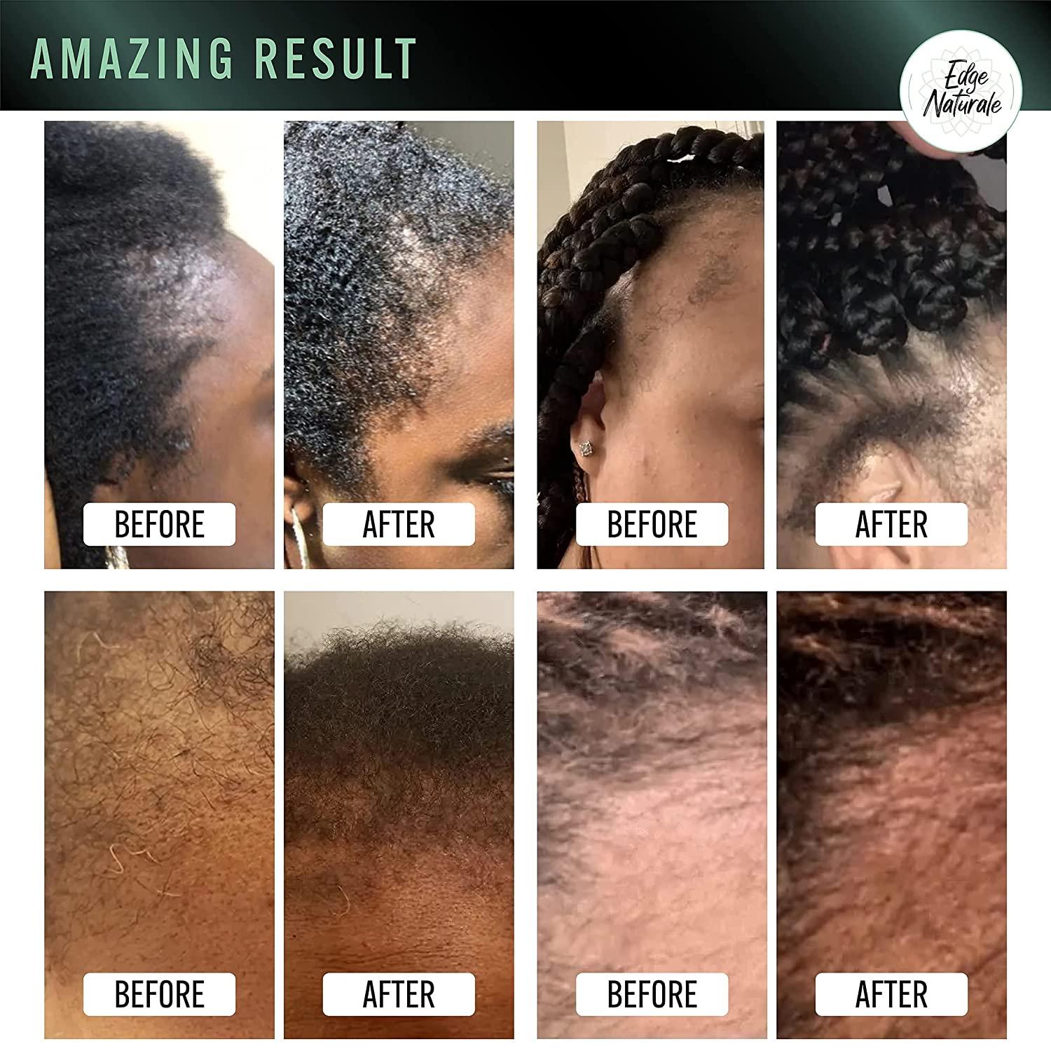 Edge Naturale Follicle Enhancer Repair and Regrow Hair Edges Growth