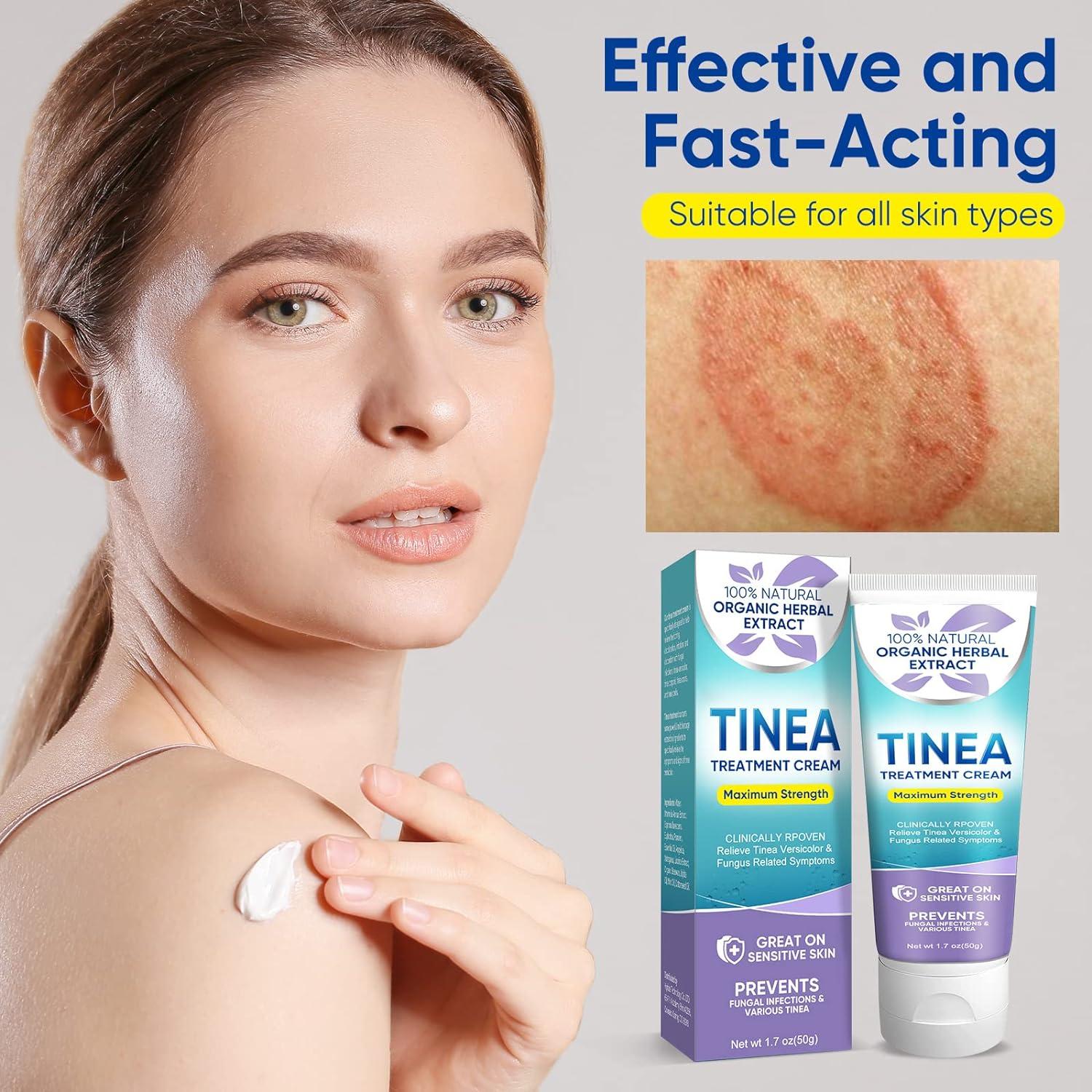 Tinea Versicolor Treatment Natural Skin Cream for All Skin Types