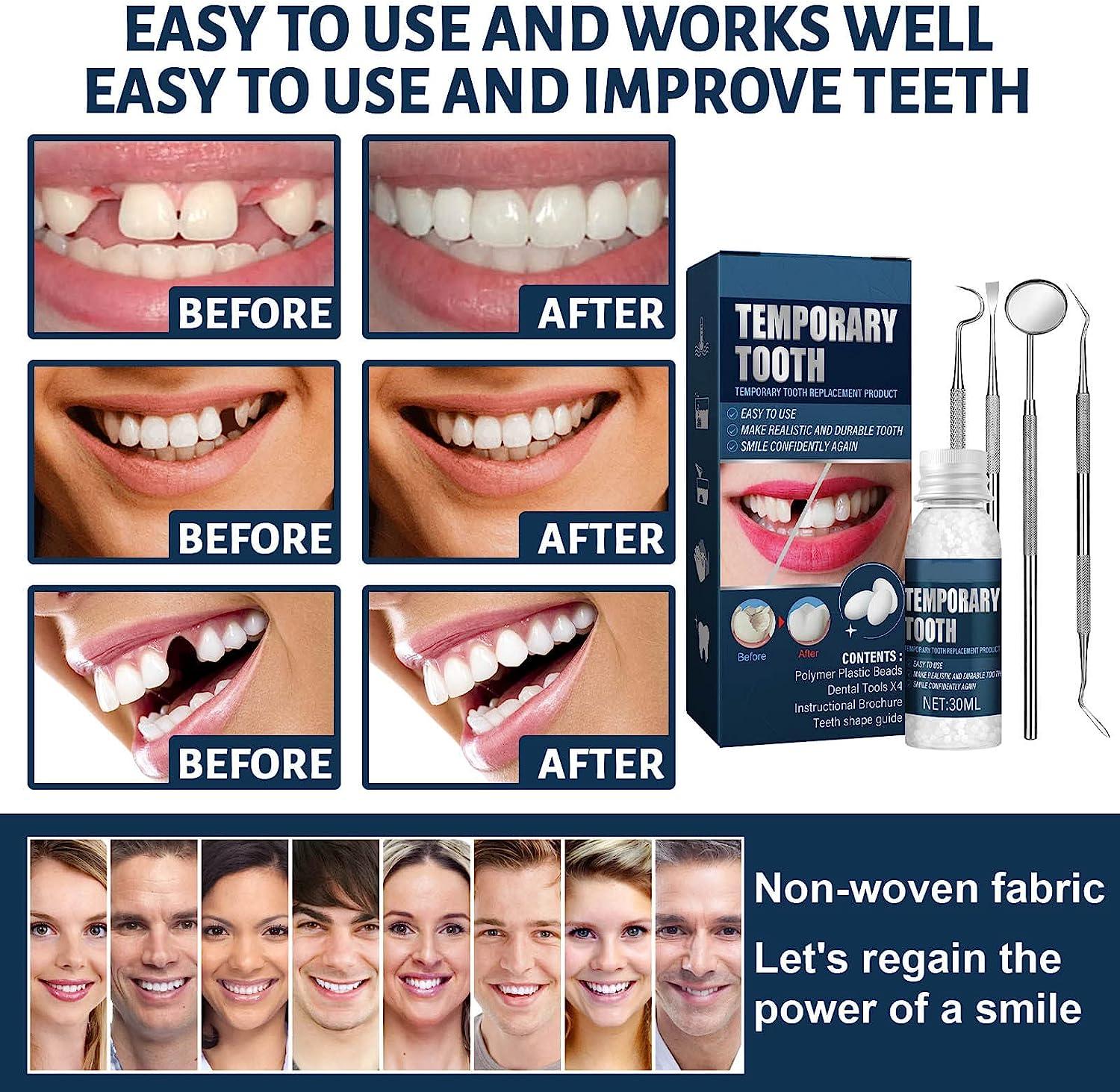 Tooth Repair Kits, Tooth Repair Moldable Fake Teeth, Dental Repair Denture  Repair Beads, For Temporary Fixing Filling Broken Tooth 1 Set