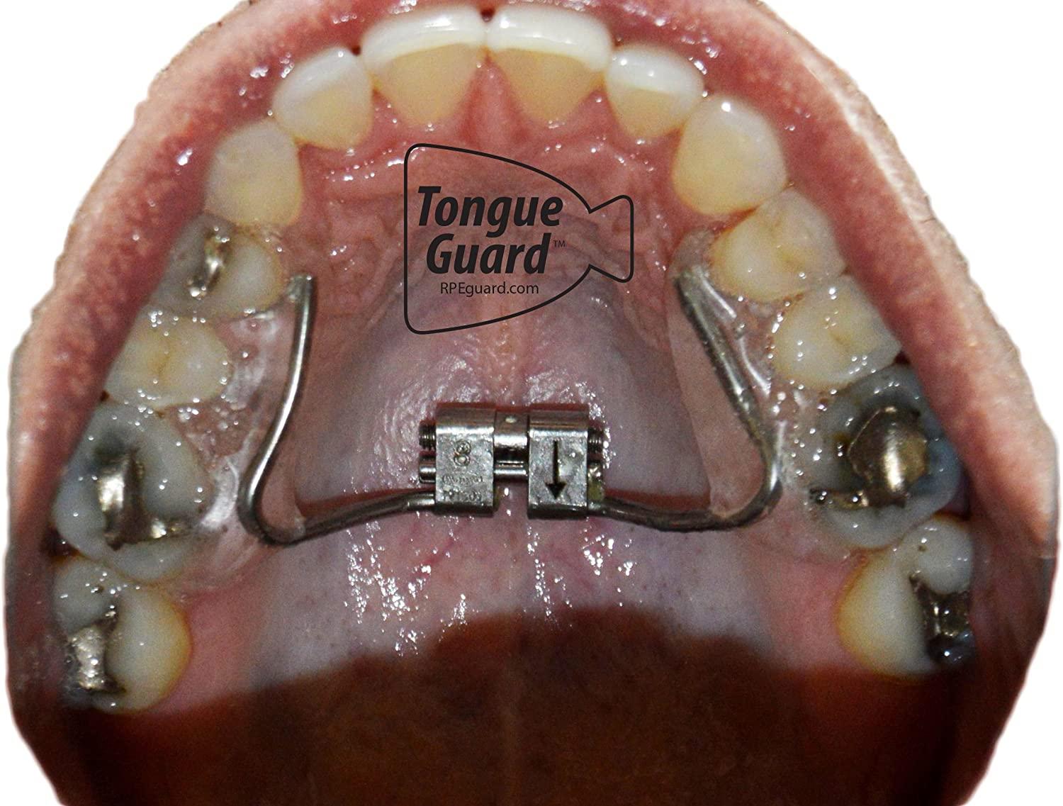 RPE Tongue Guard Prevents and Heals Tongue Sores from Dental Expanders