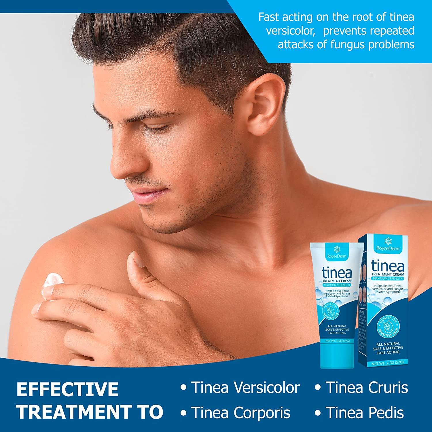 Roycederm Antifungal Cream for Tinea Versicolor, Athlete's Foot & Ringworm Treatment Fast