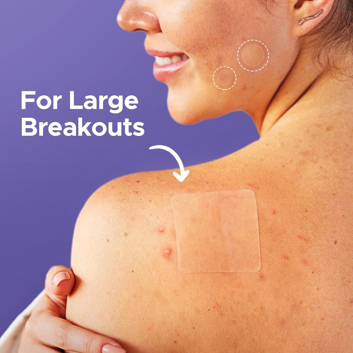 LitBear Large Pimple Patches Acne Patches for Face Chin Cheek Forehead