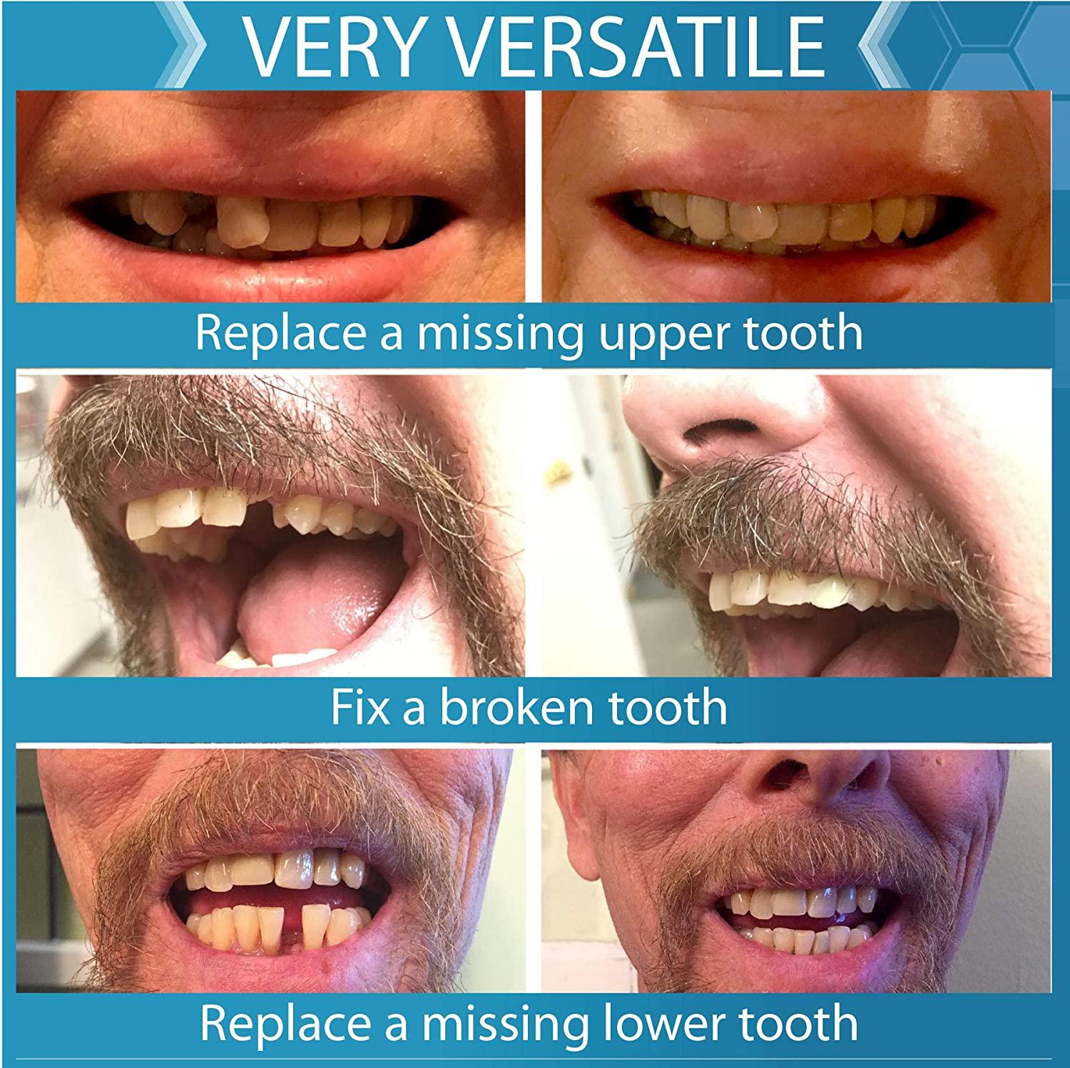 Instant Smile Tooth Replacement Kit Complete Your Smile in Minutes(04)
