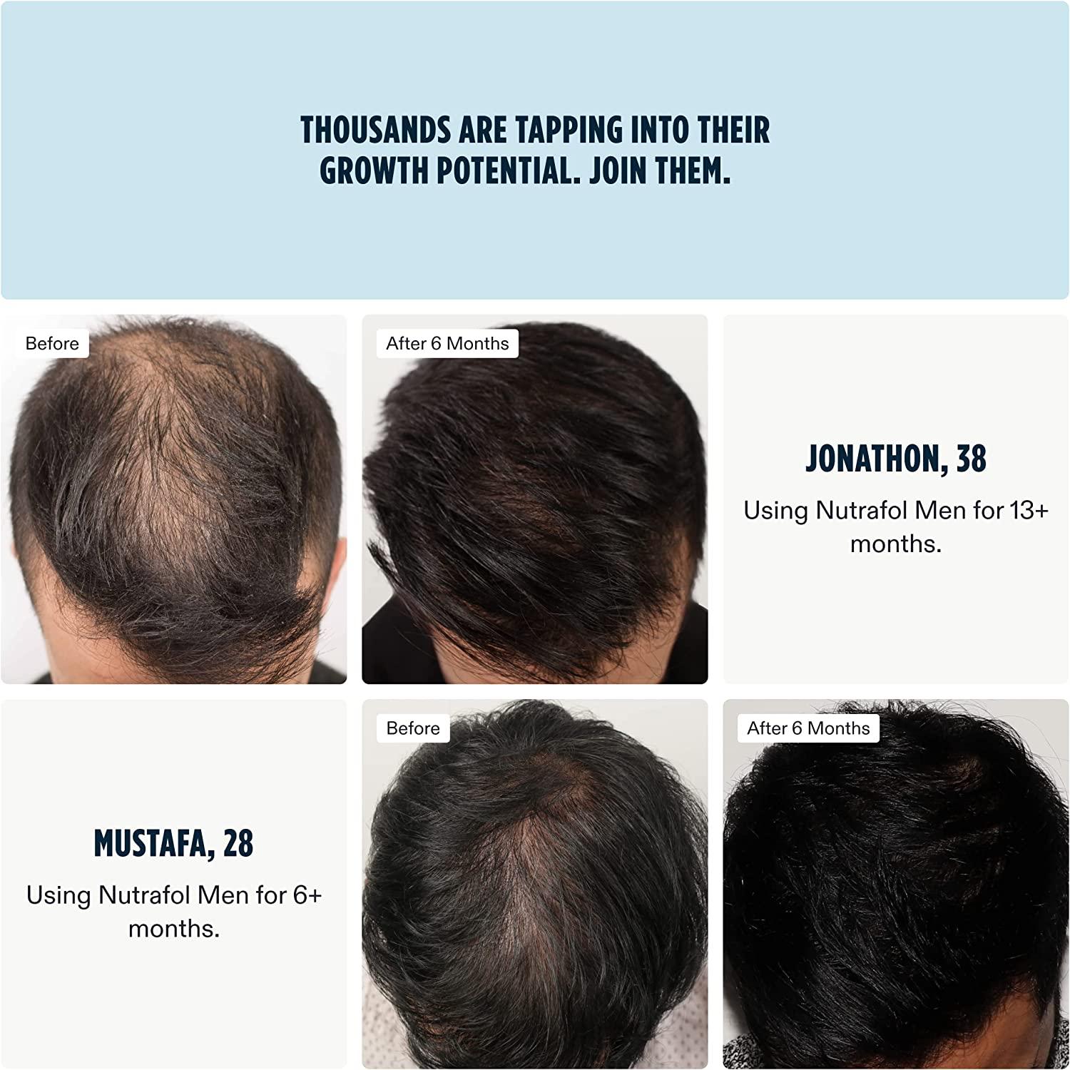Nutrafol Men's Hair Growth Supplement, Clinically Proven for  Thicker-Looking, Stronger-Feeling Hair and More Scalp Coverage (2-Month  Supply) (2 Refill Pouches)