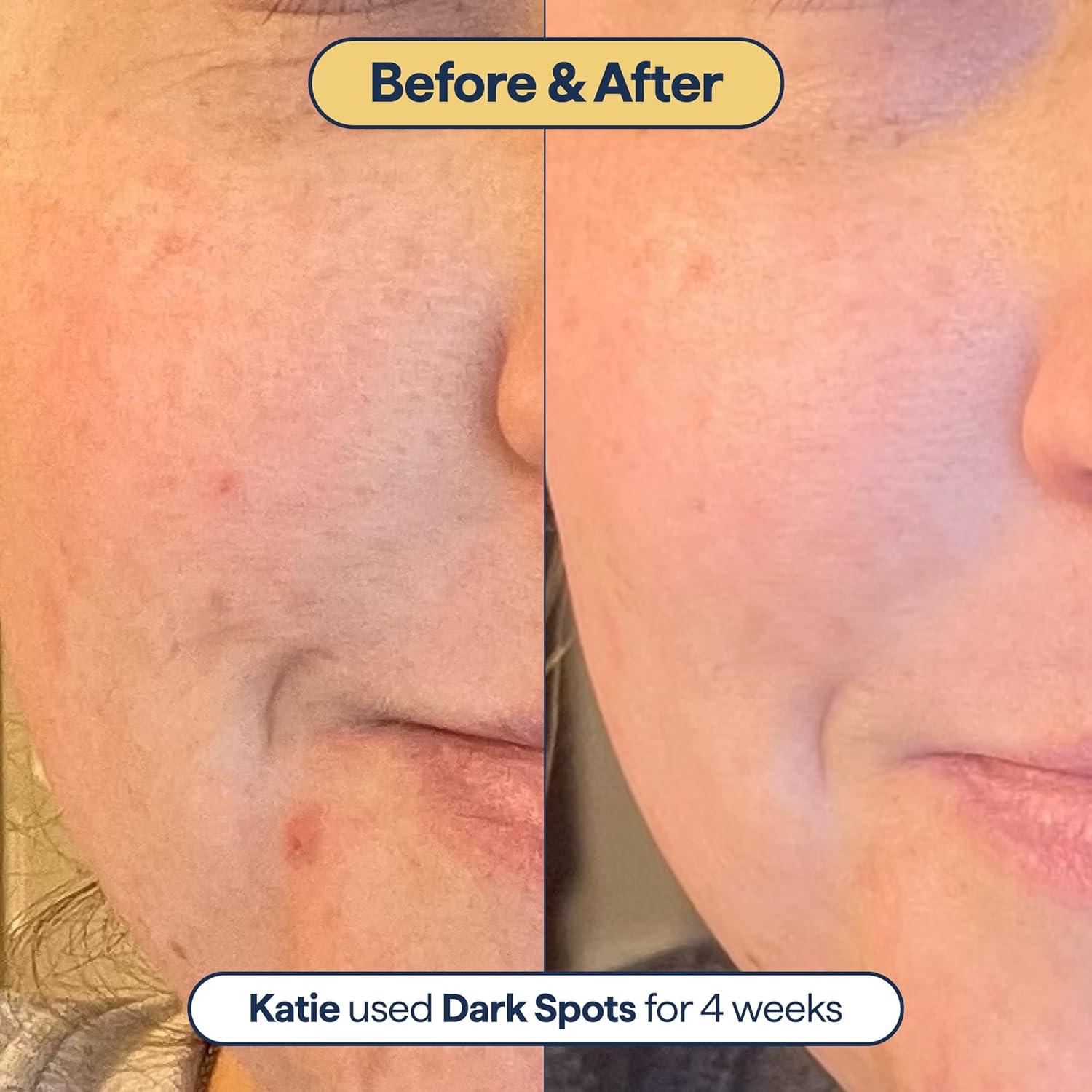 Remedy For Dark Spots Nightly All In One Treatment - 1Fl Oz | Buy Now with  Express International Delivery | GoSupps.com