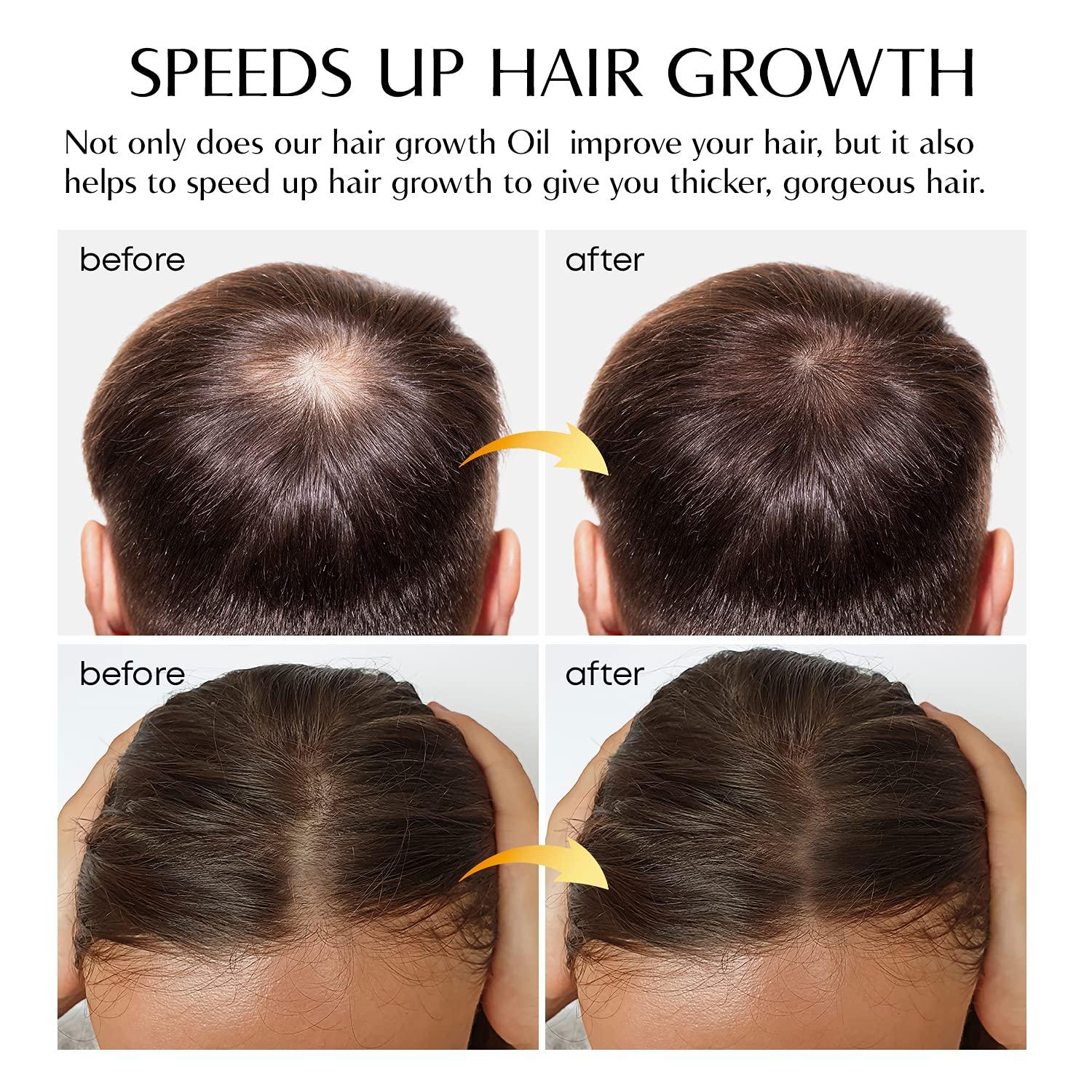 Hair Growth Serum Ginger Hair Growth Oil Ginger Prevent Hair Loss and  Natural Serum for Thicker, Stronger, Longer Hair Men and Women All Hair  Types  Oz (50 mL)