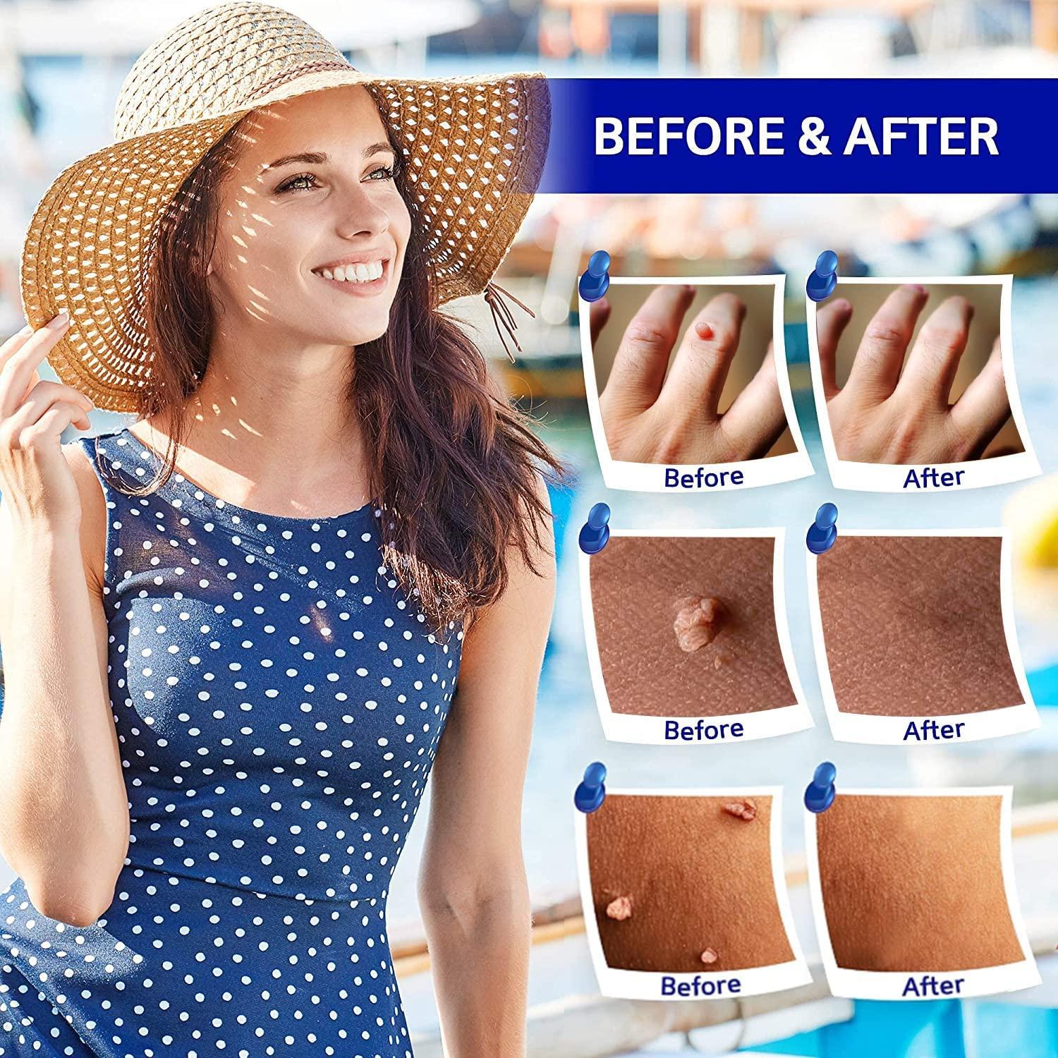 Getsocio Skin Tag & Mole Remover Set Repair Skin, Remove Blemishes