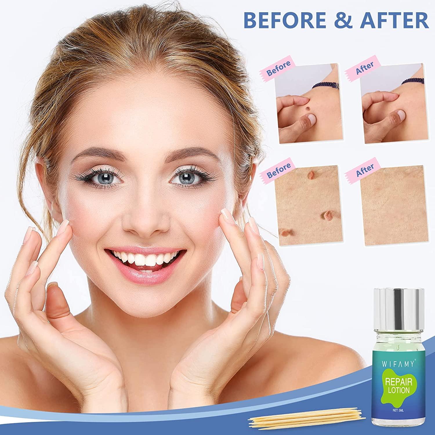 mole removal cream before and after