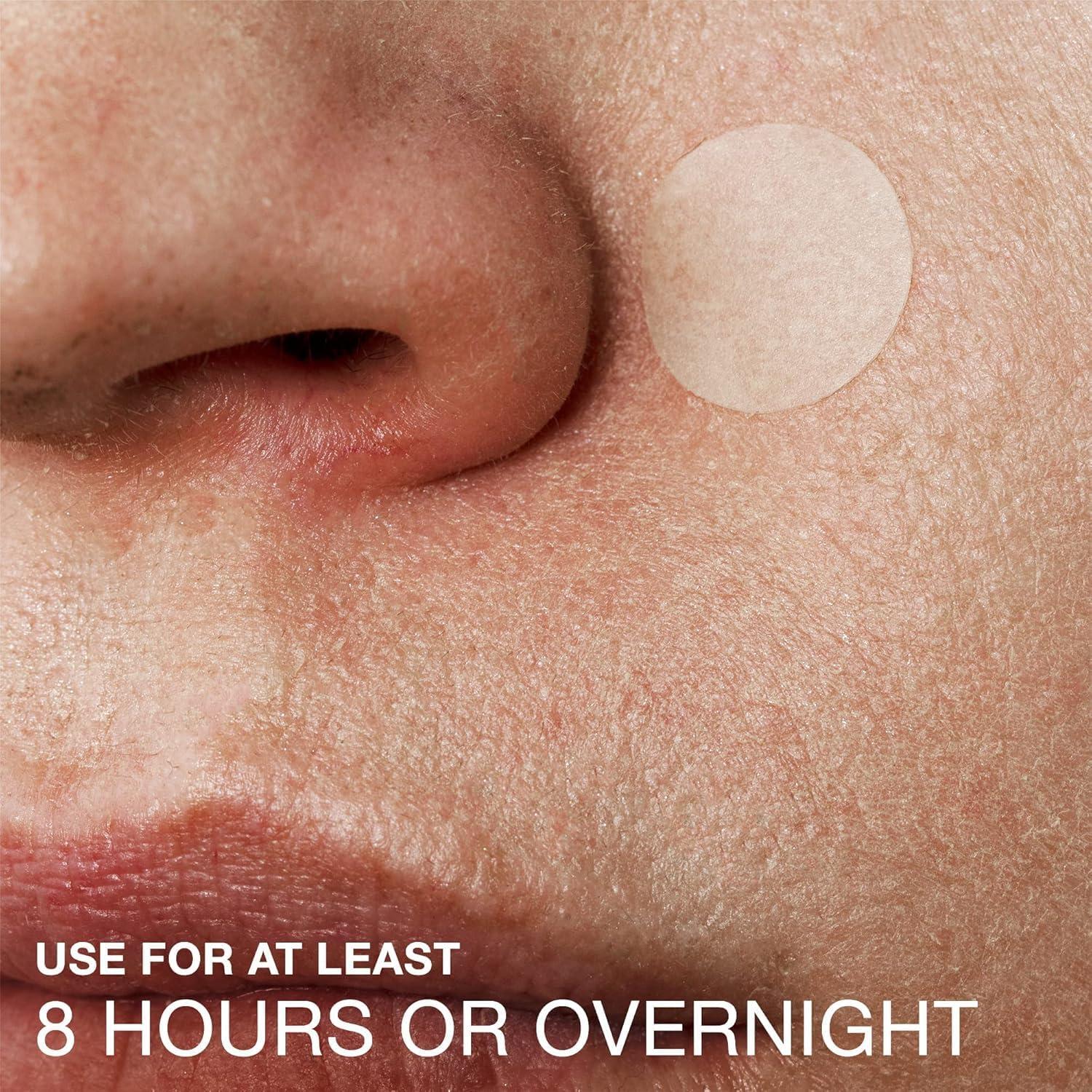 Nonprescription acne treatment: Which products work best?