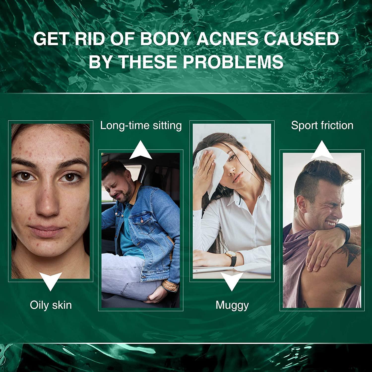 Butt & Thigh Anti Acne Cream,Body Acne Cream,Removing Acne,Pimples and Ingrown Hairs for