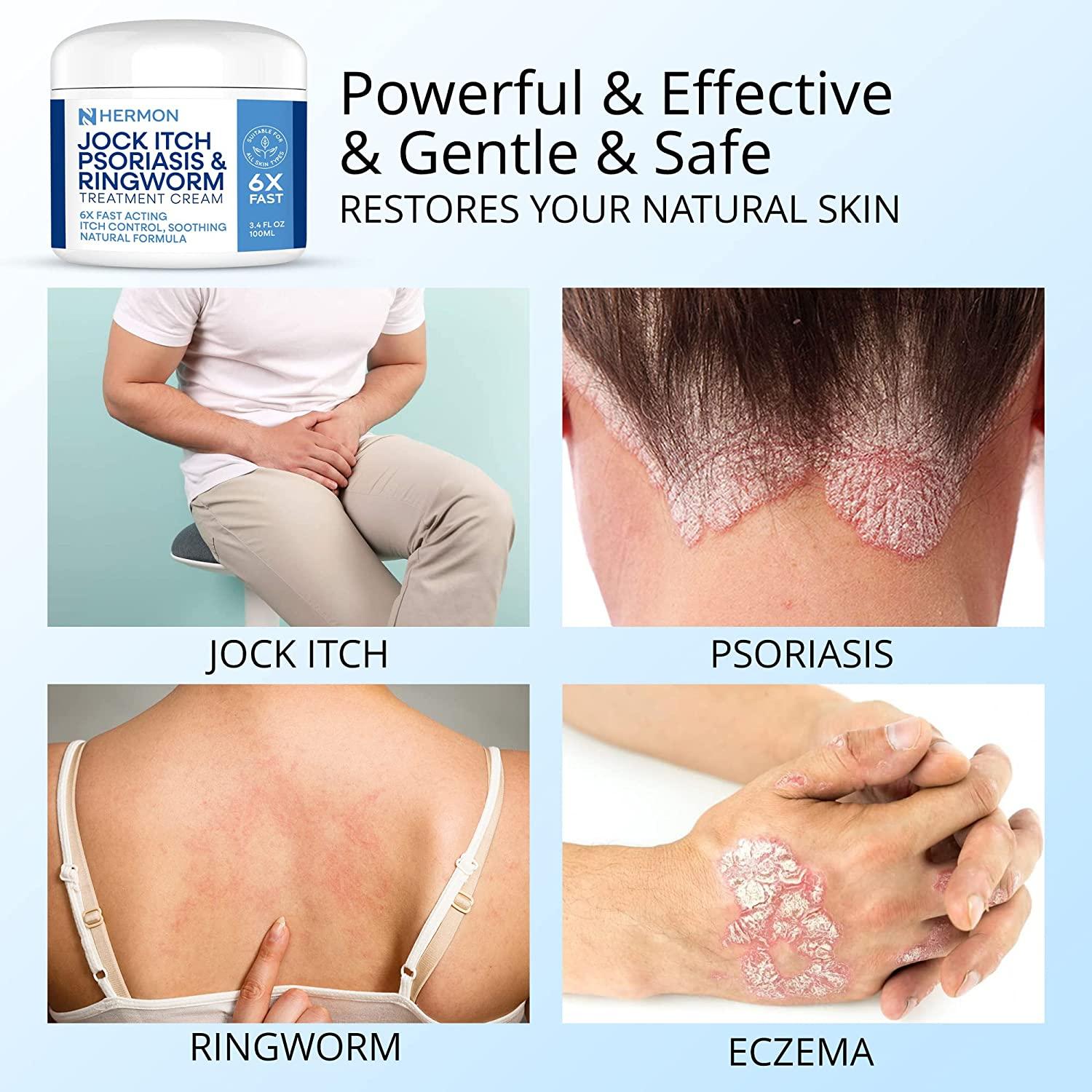 Antifungal Cream for Jock Itch, Psoriasis & Ringworm Treatment 100g